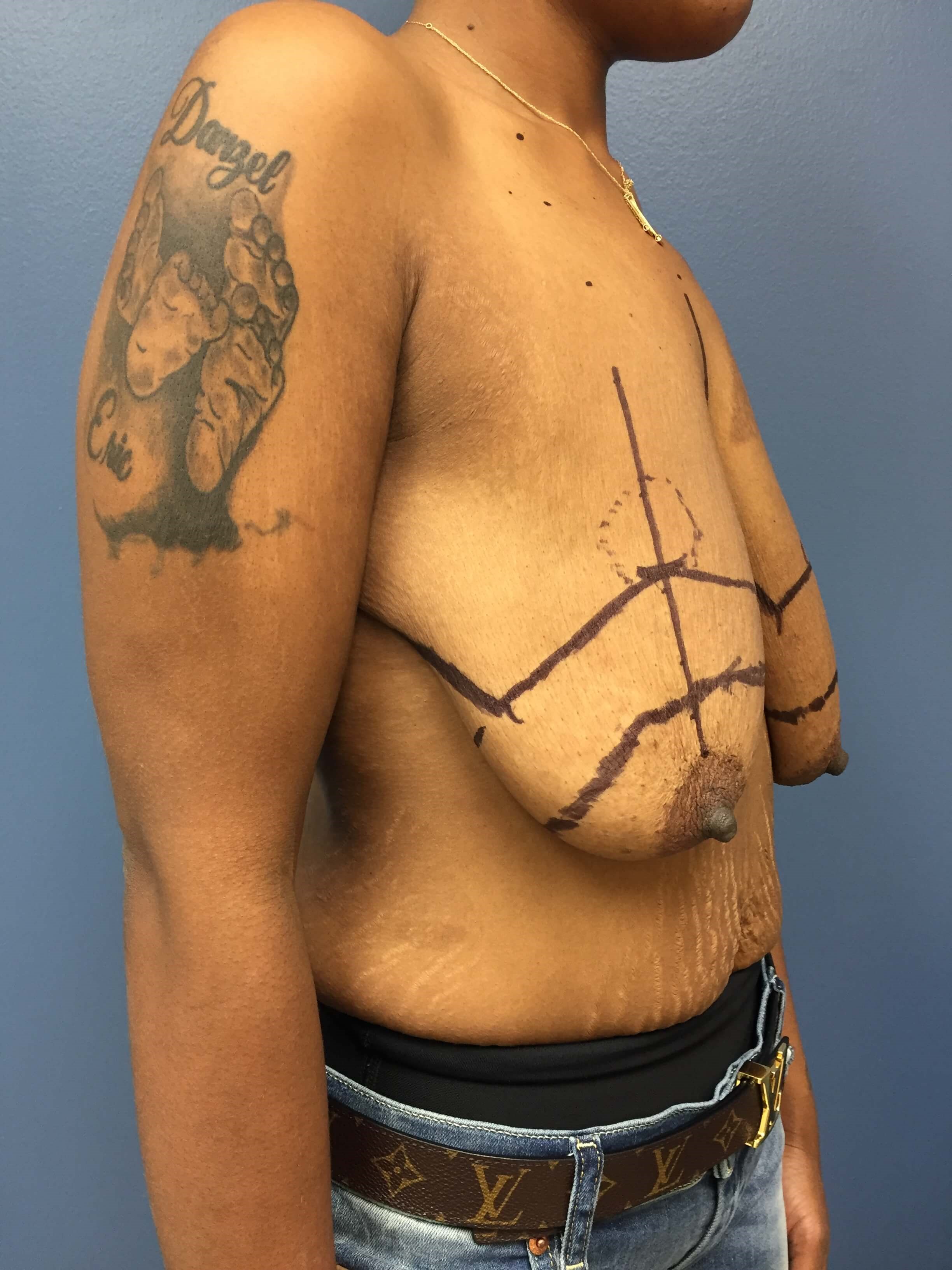 Westlake Woman Has Breast Lift Before
