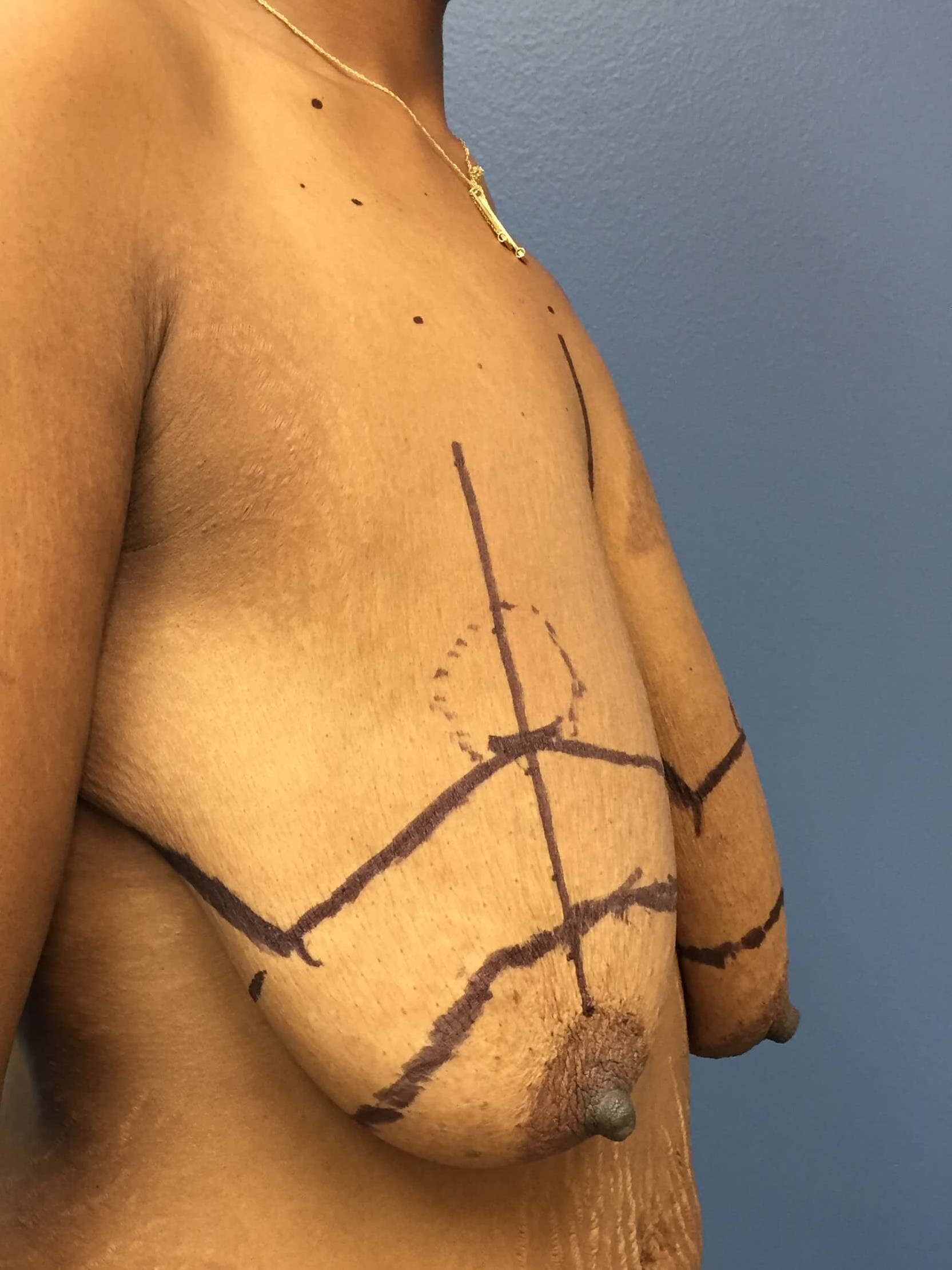 Westlake Woman Has Breast Lift Before