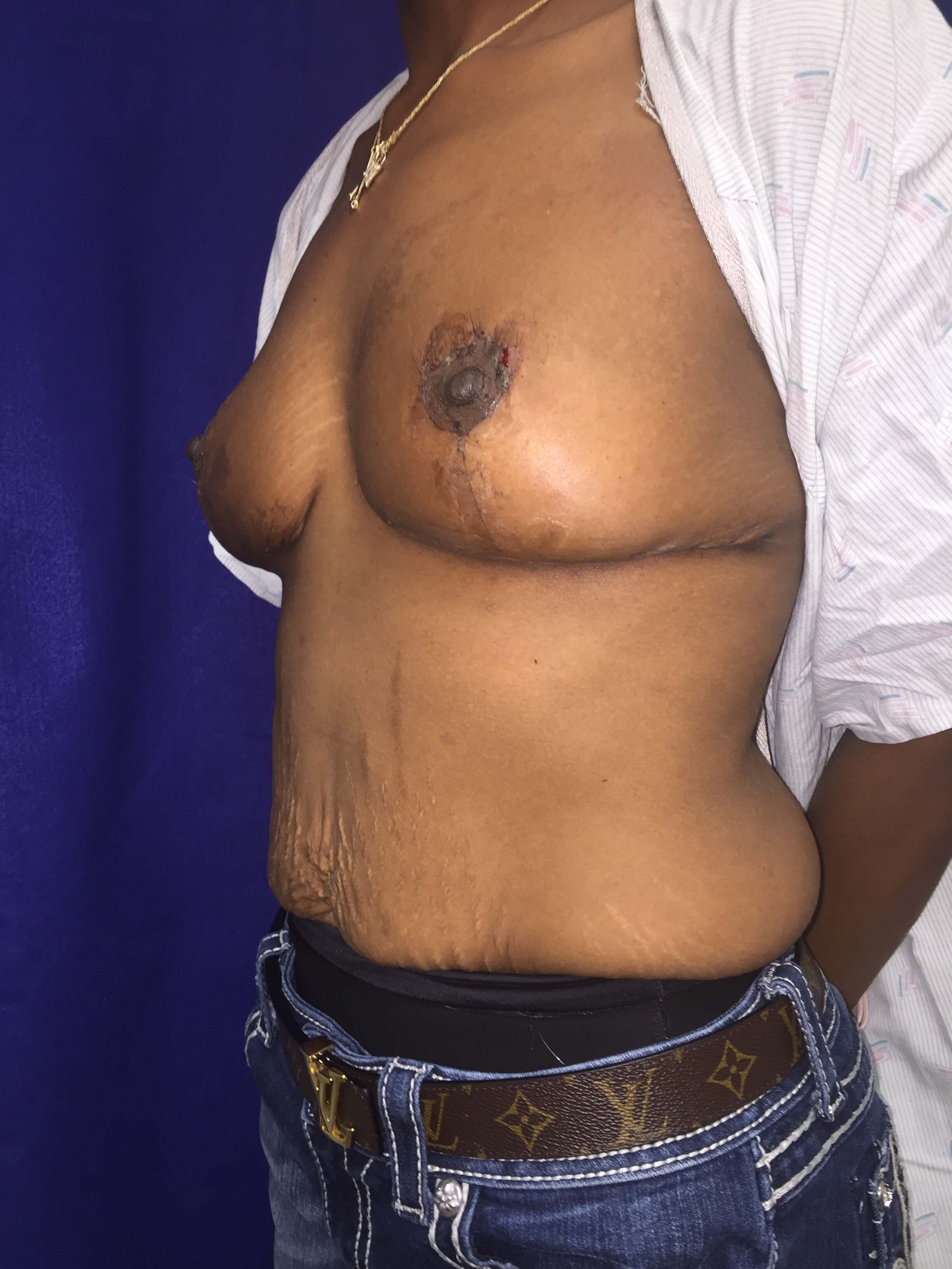 Westlake Woman Has Mastopexy After