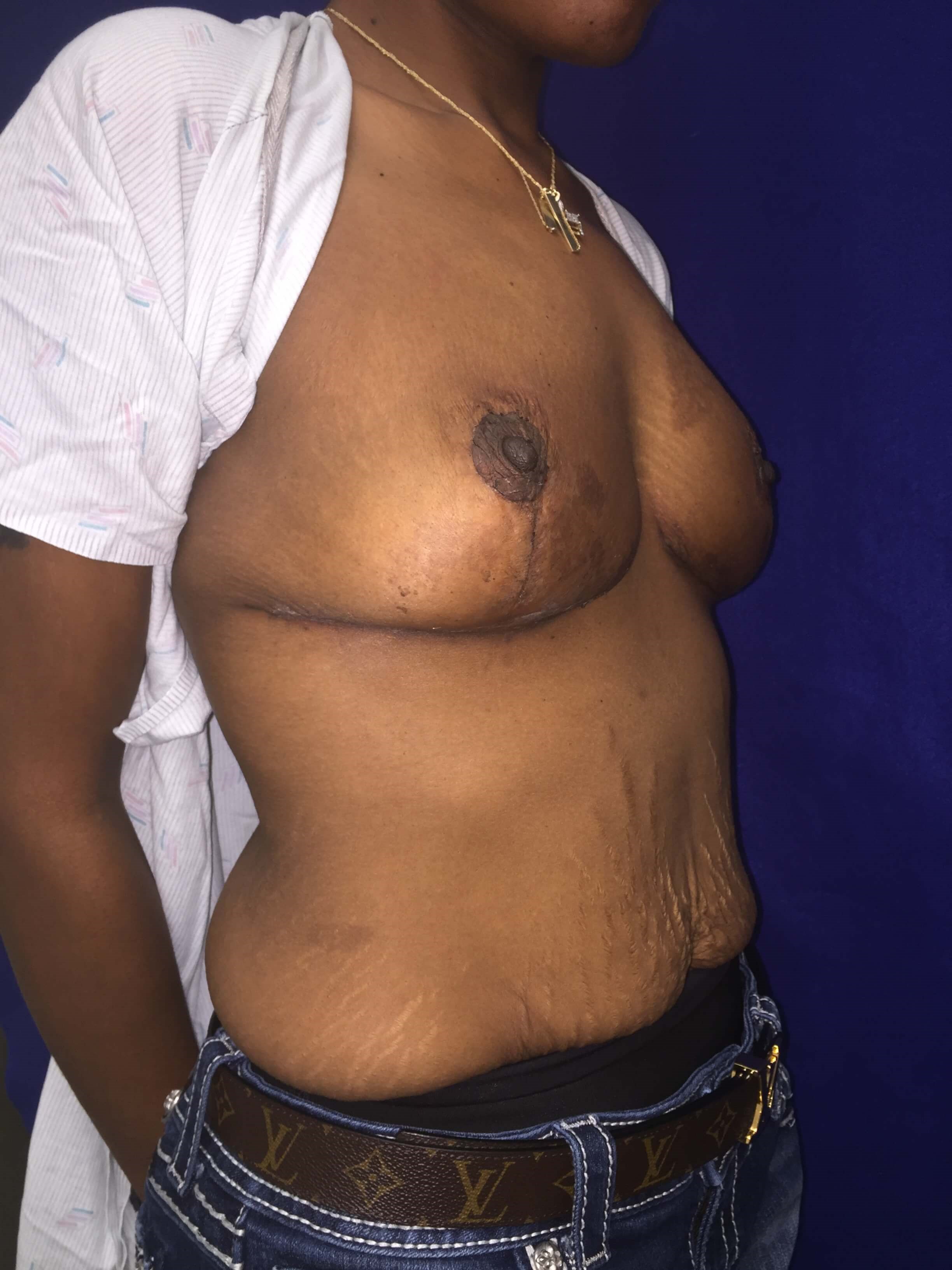 Westlake Woman Has Breast Lift After