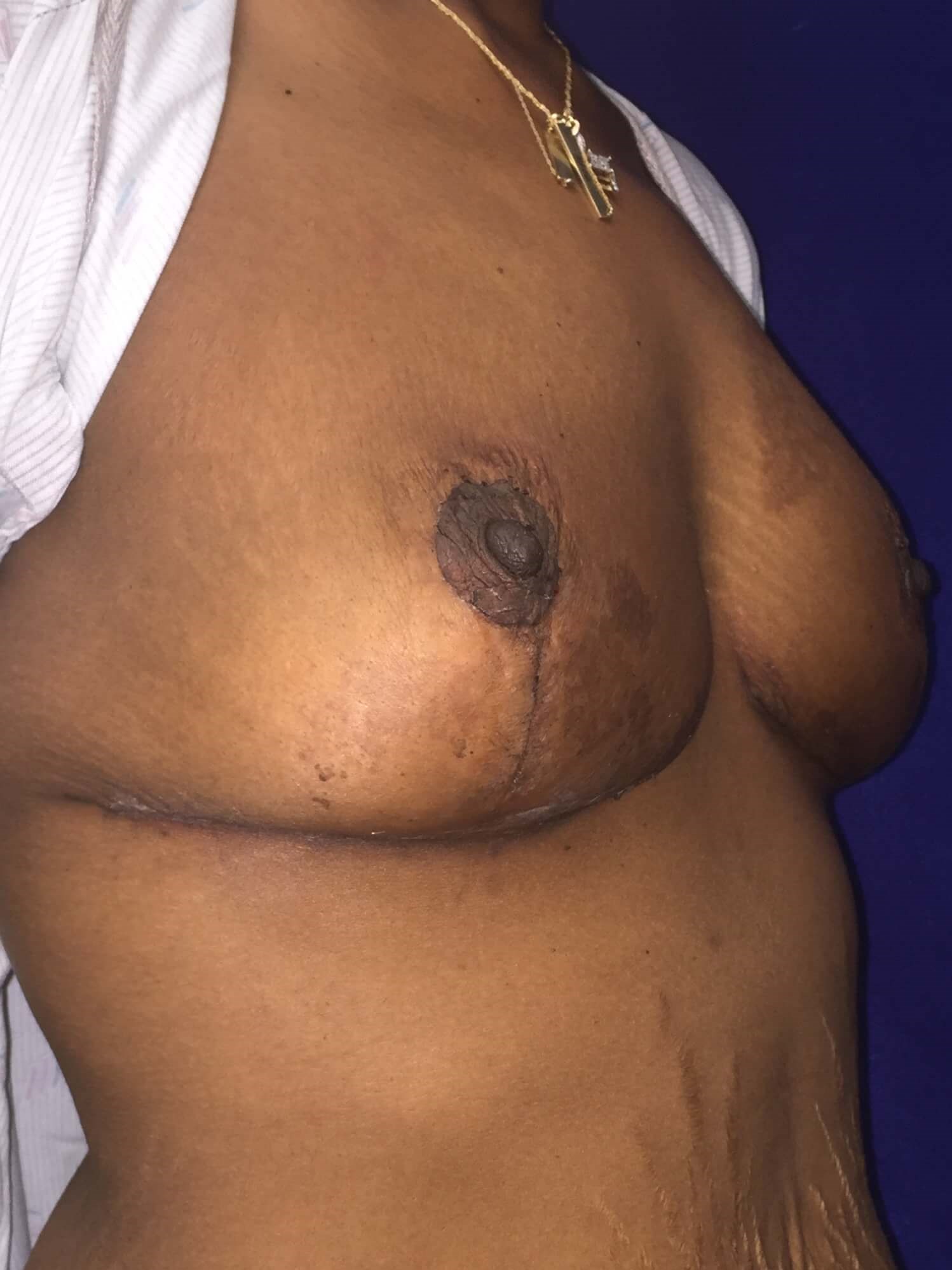 Westlake Woman Has Breast Lift After