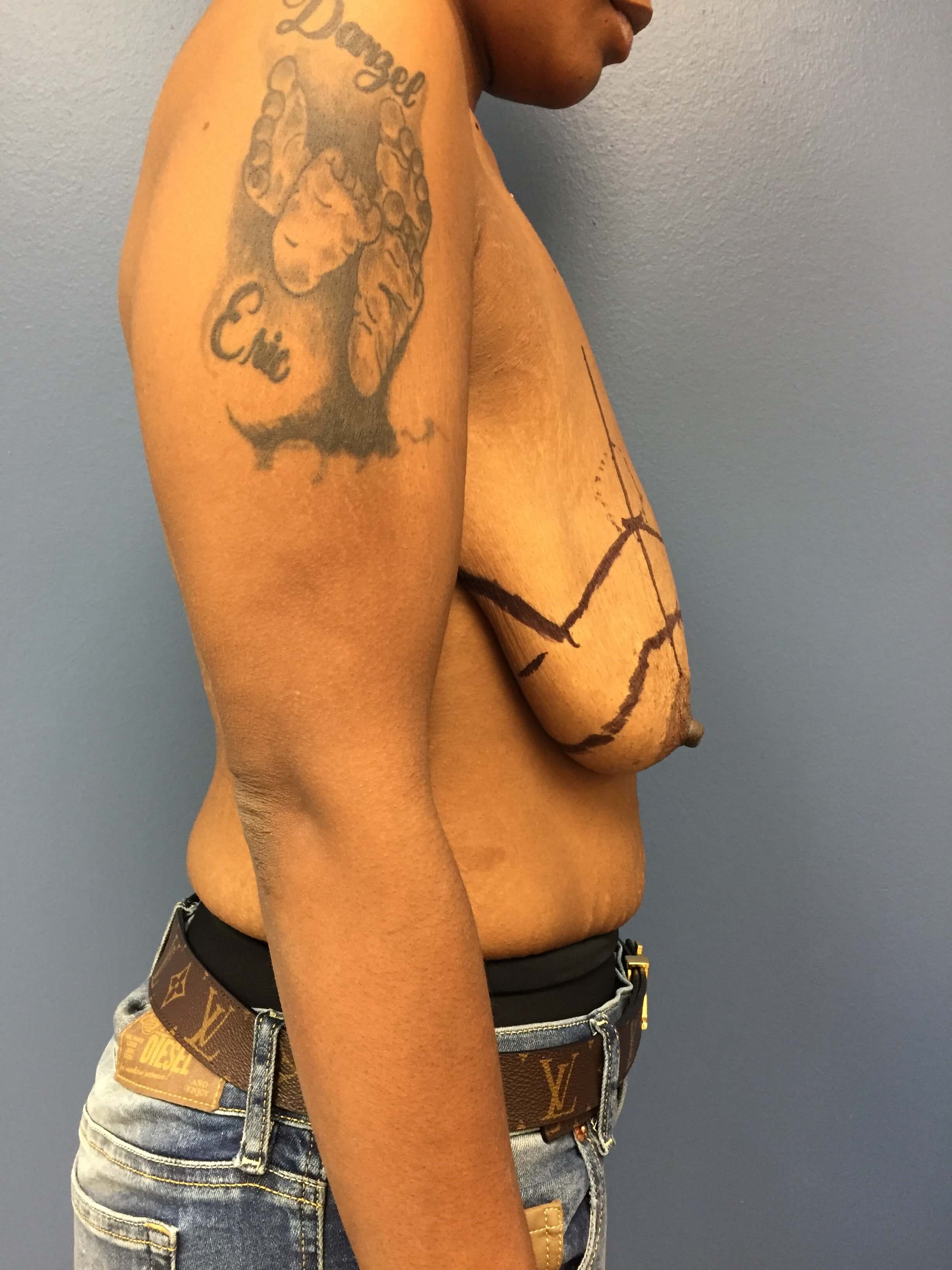 Westlake Woman Has Mastopexy Before