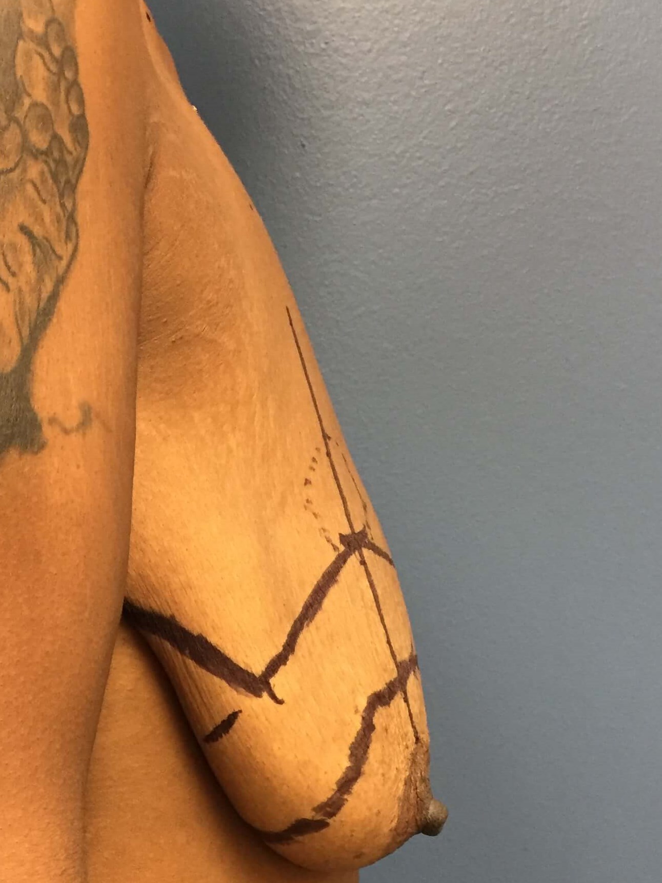 Westlake Woman Has Mastopexy Before