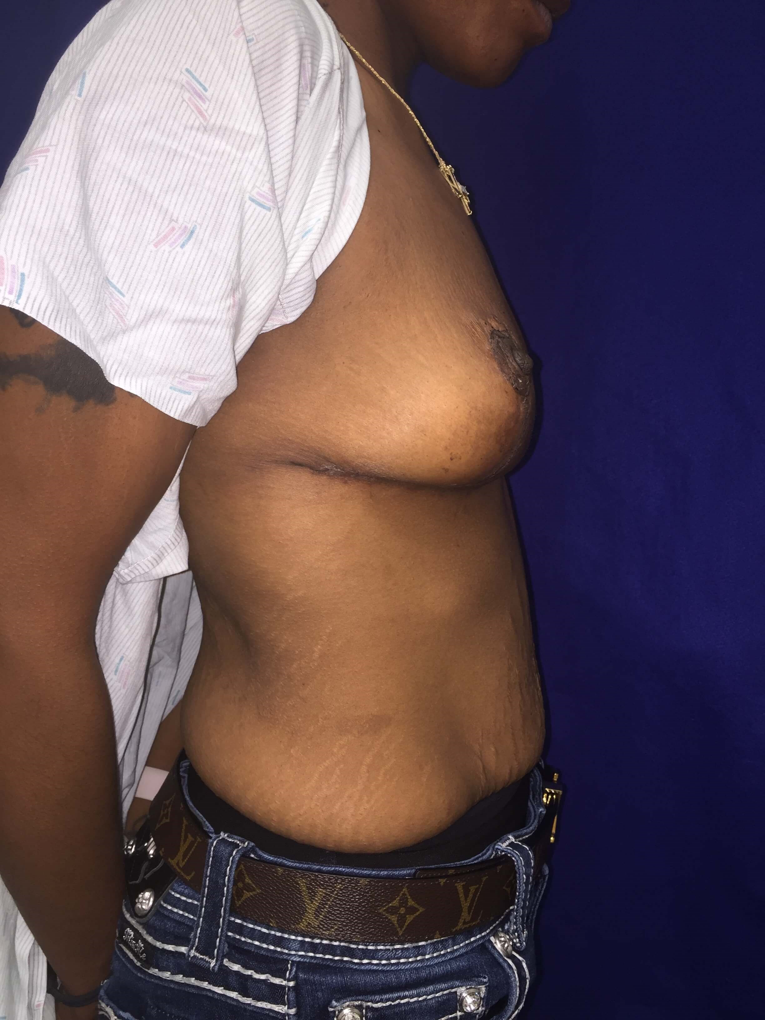 Westlake Woman Has Mastopexy After