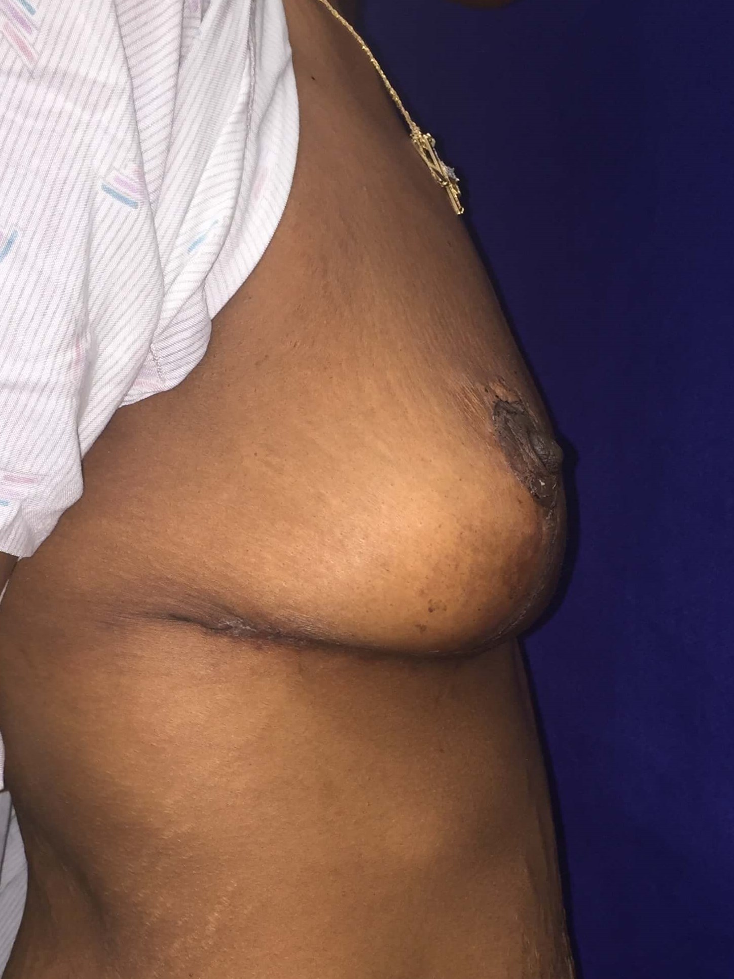 Westlake Woman Has Mastopexy After