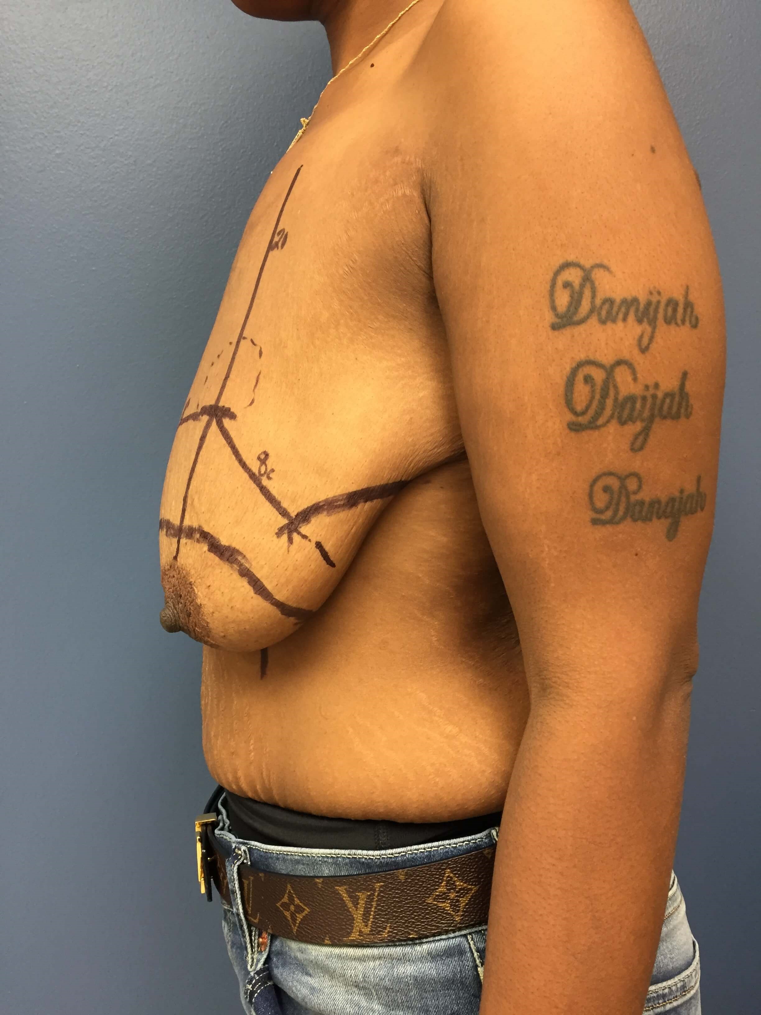 Westlake Woman Has Mastopexy Before