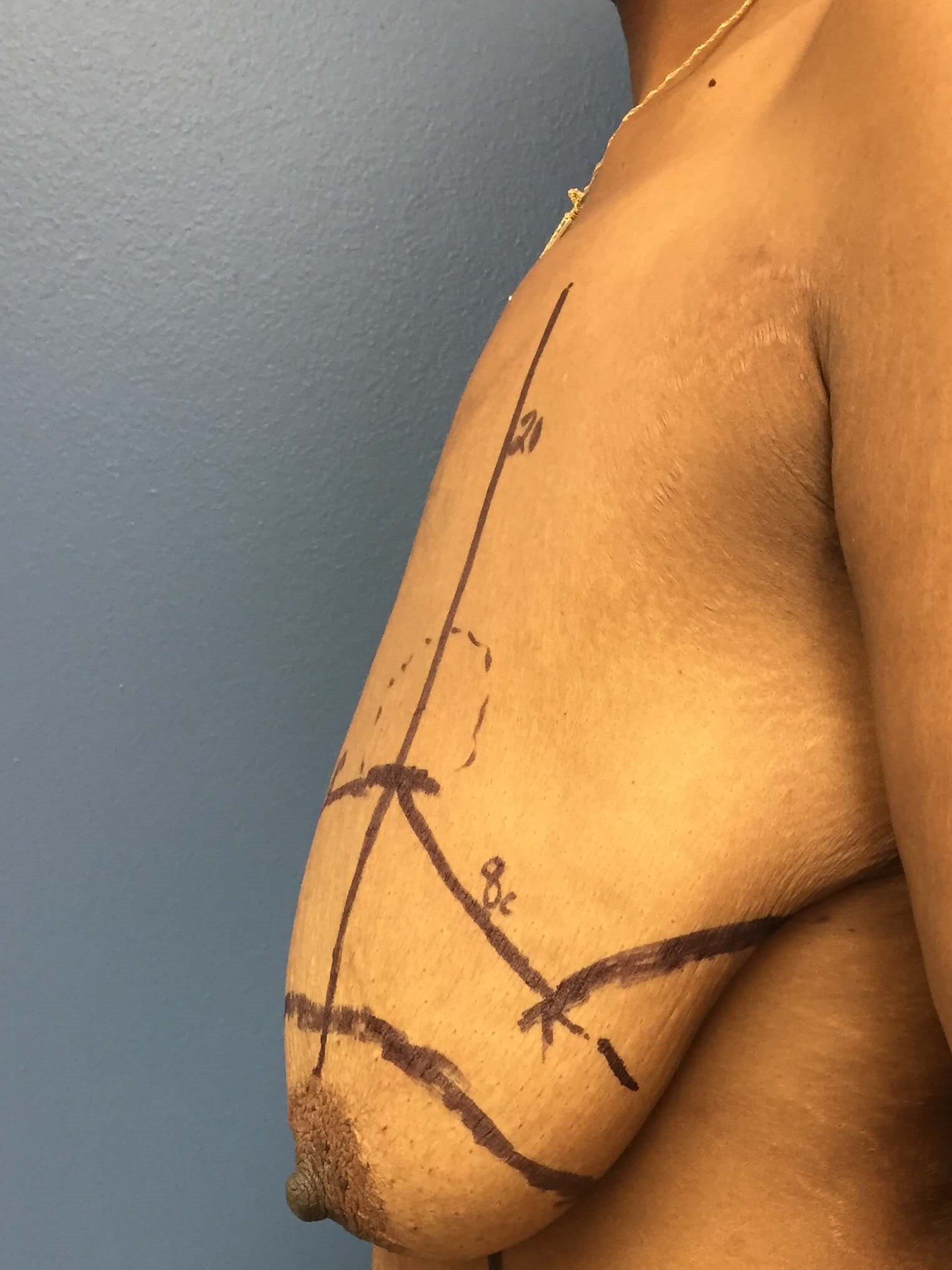Westlake Woman Has Mastopexy Before