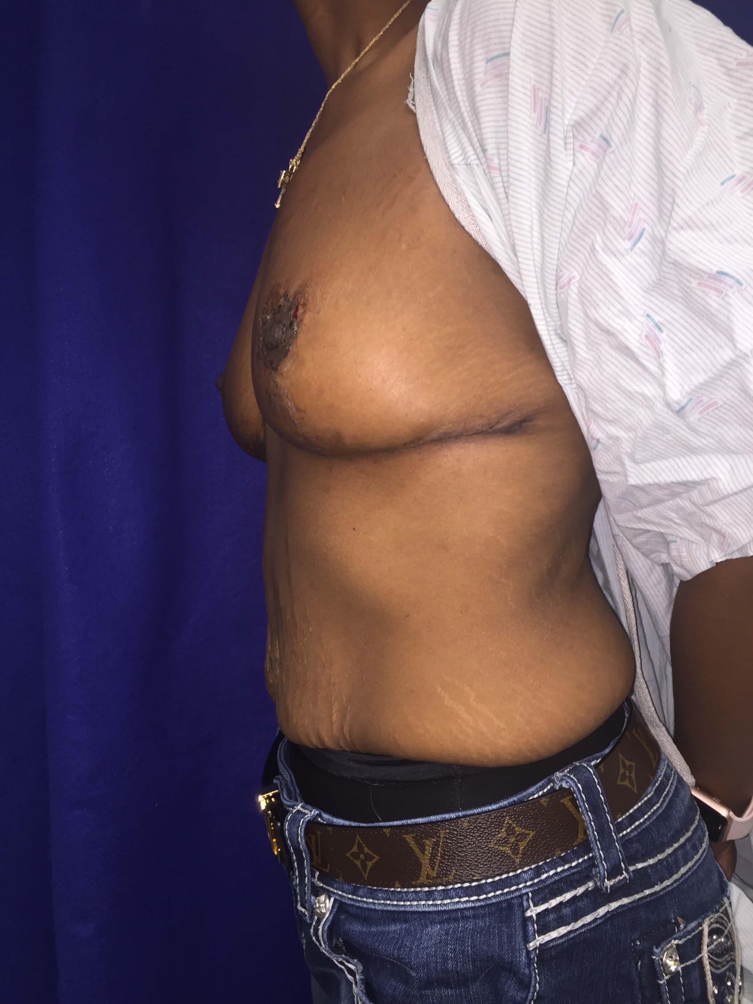 Westlake Woman Has Mastopexy After