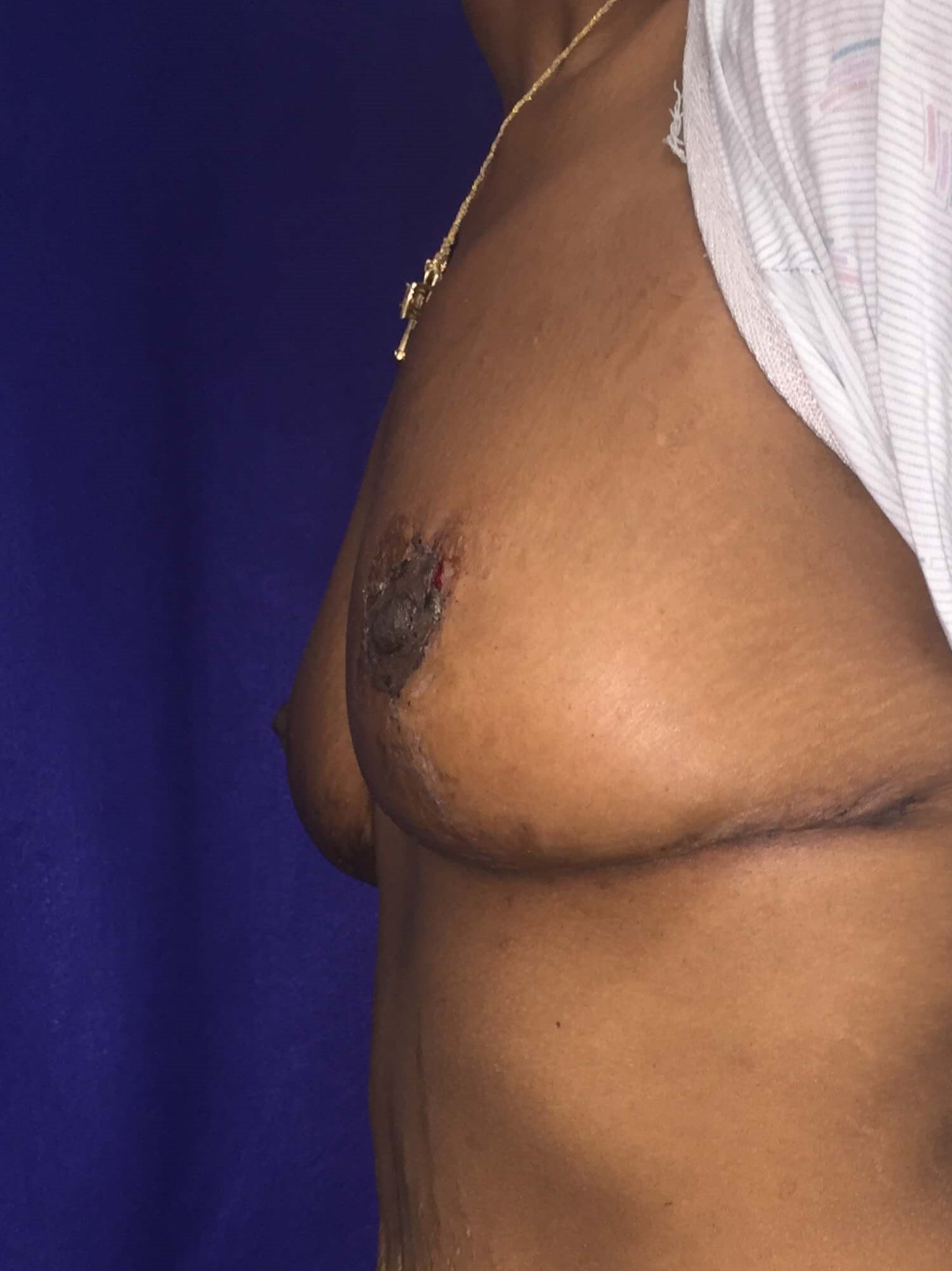 Westlake Woman Has Mastopexy After