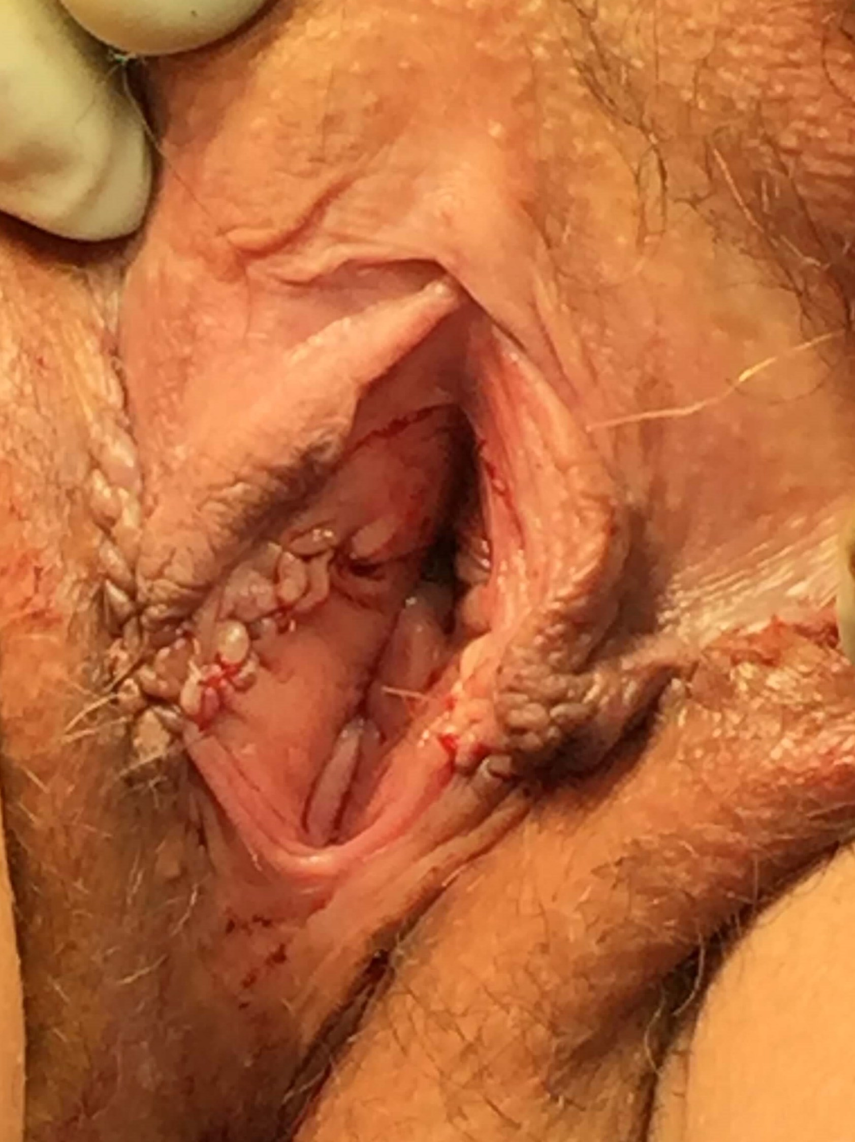 Westlake Woman has Labiaplasty After