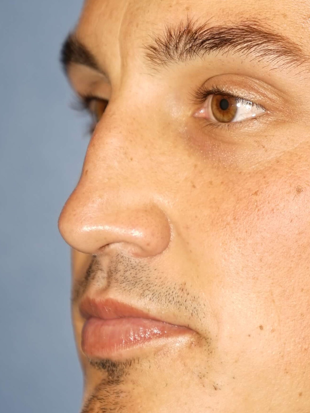 Man has Revision Rhinoplasty Before