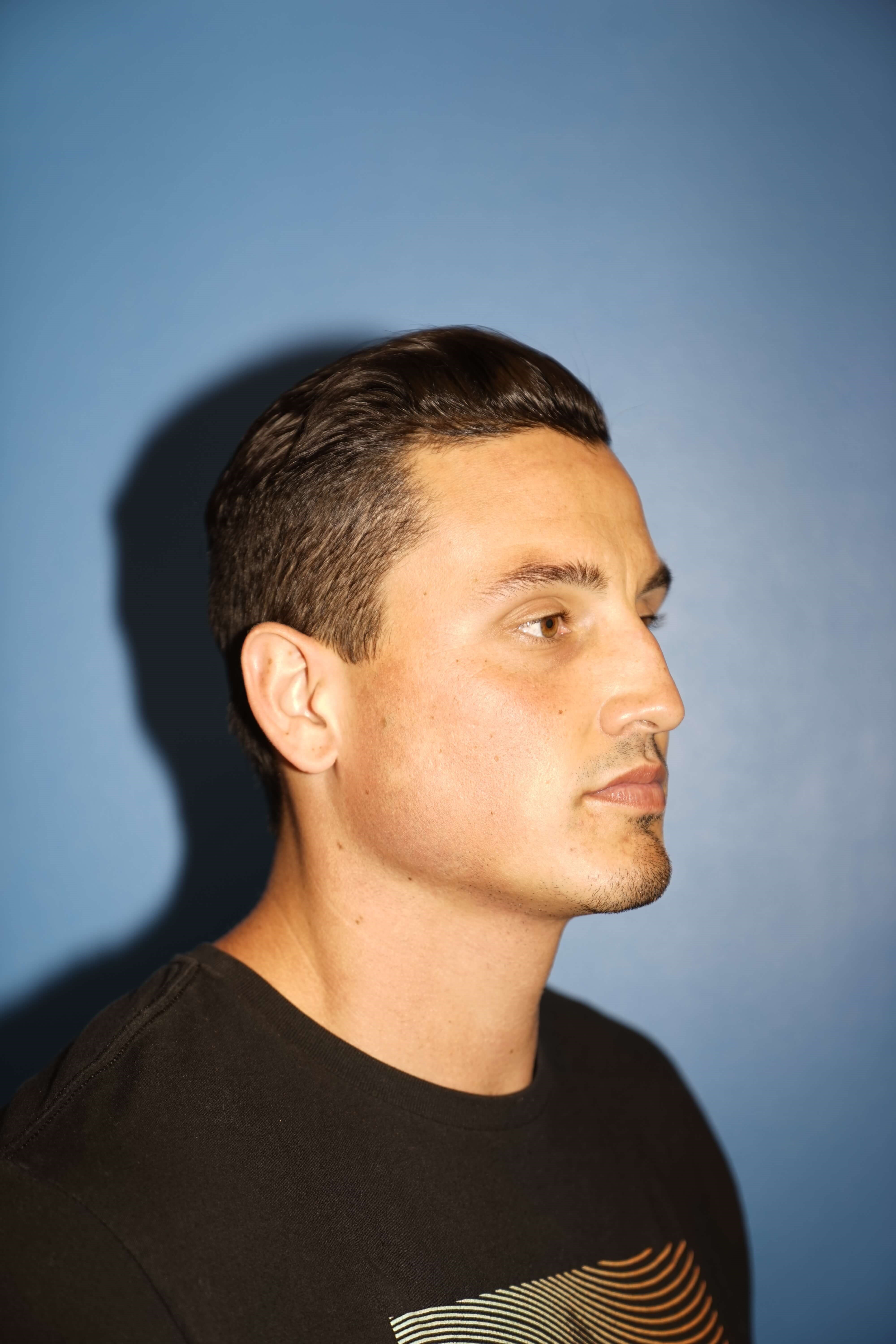 Man has Revision Rhinoplasty Before