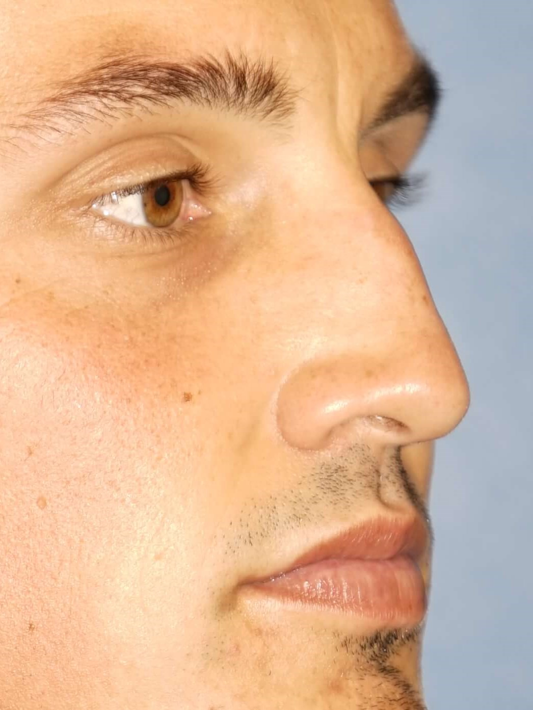 Man has Revision Rhinoplasty Before
