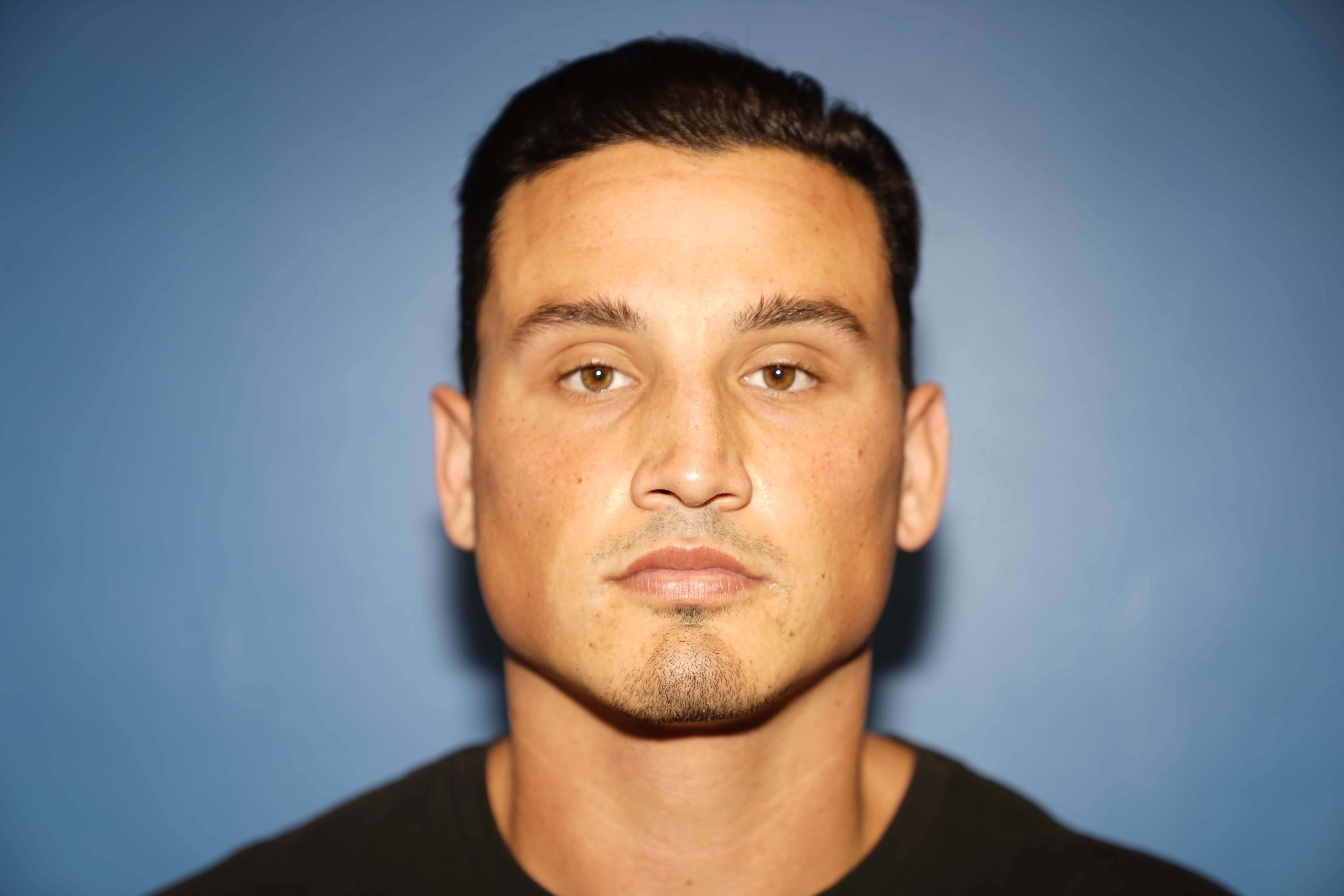 Man has Revision Rhinoplasty Before