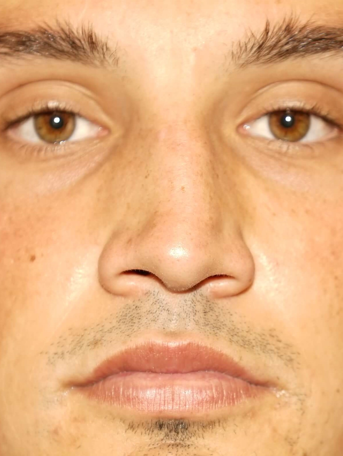Man has Revision Rhinoplasty Before