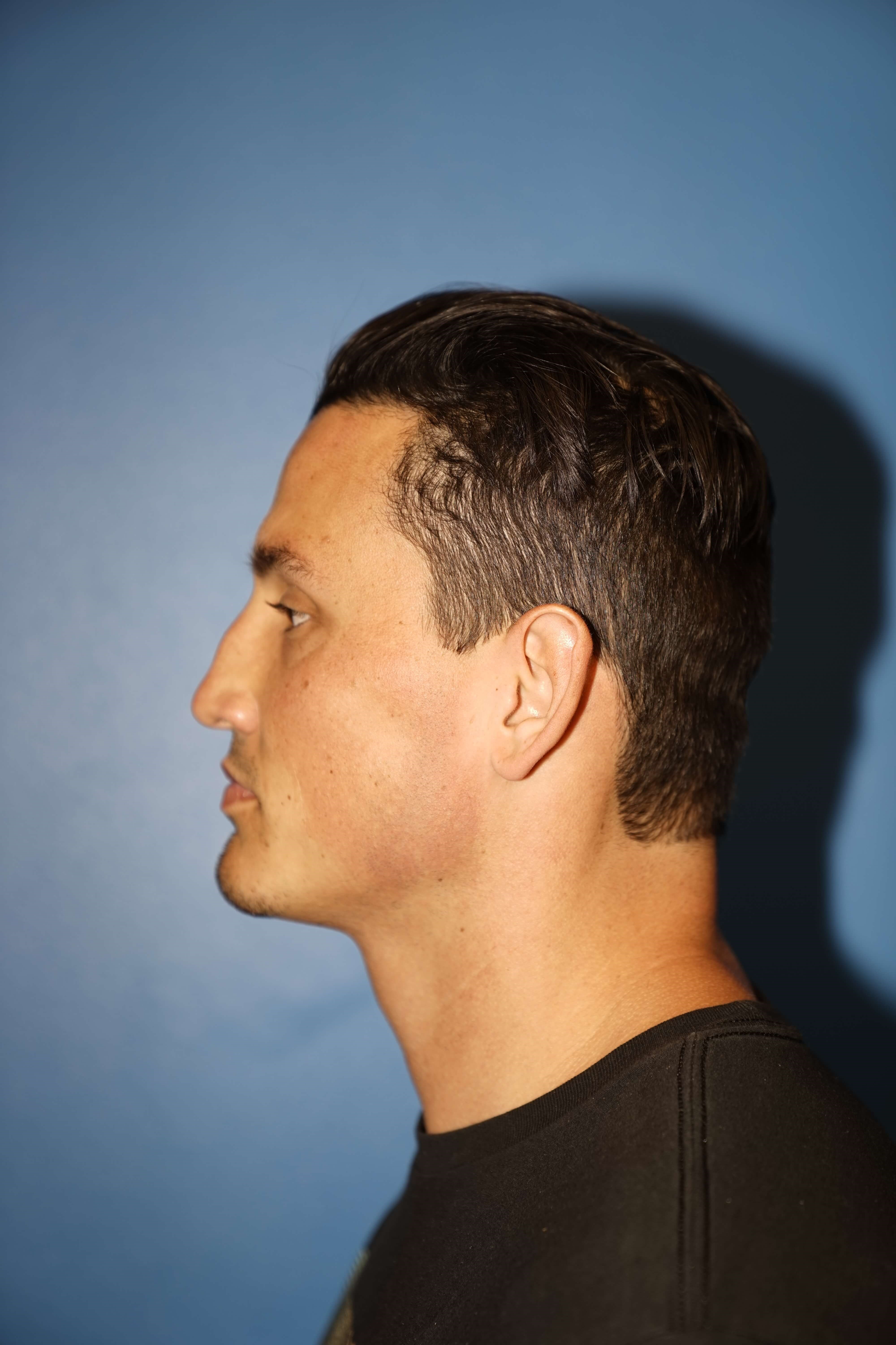 Man has Revision Rhinoplasty Before