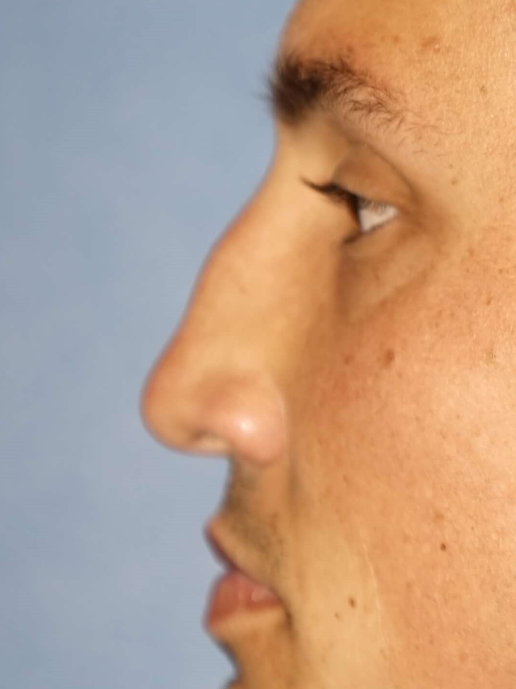 Man has Revision Rhinoplasty Before
