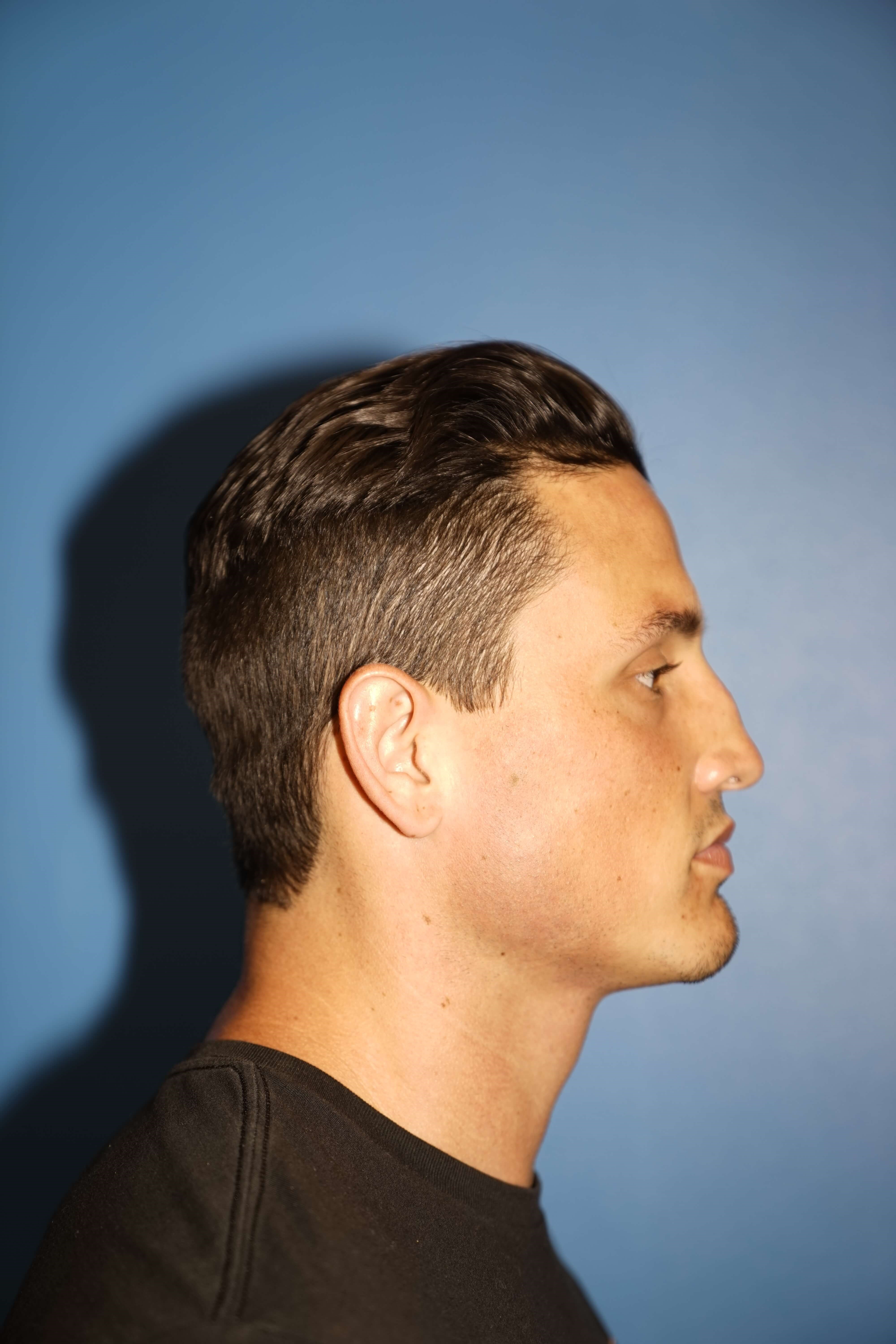 Man has Revision Rhinoplasty Before