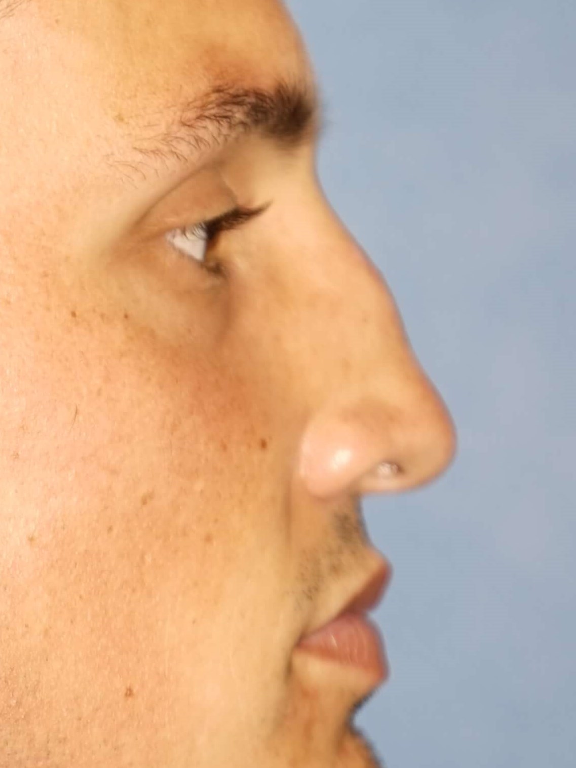 Man has Revision Rhinoplasty Before
