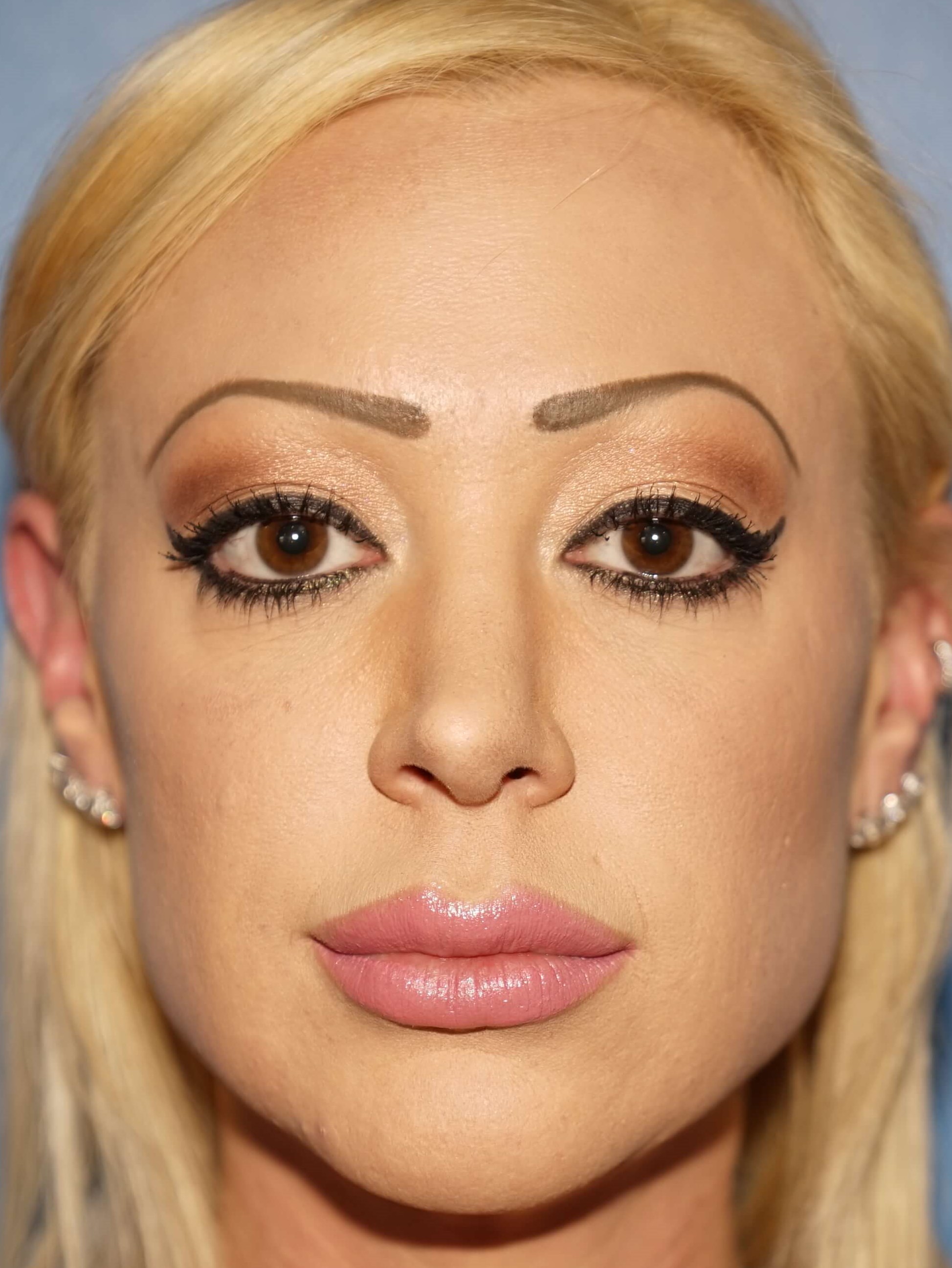 Woman has Facial Rejuvenation Before