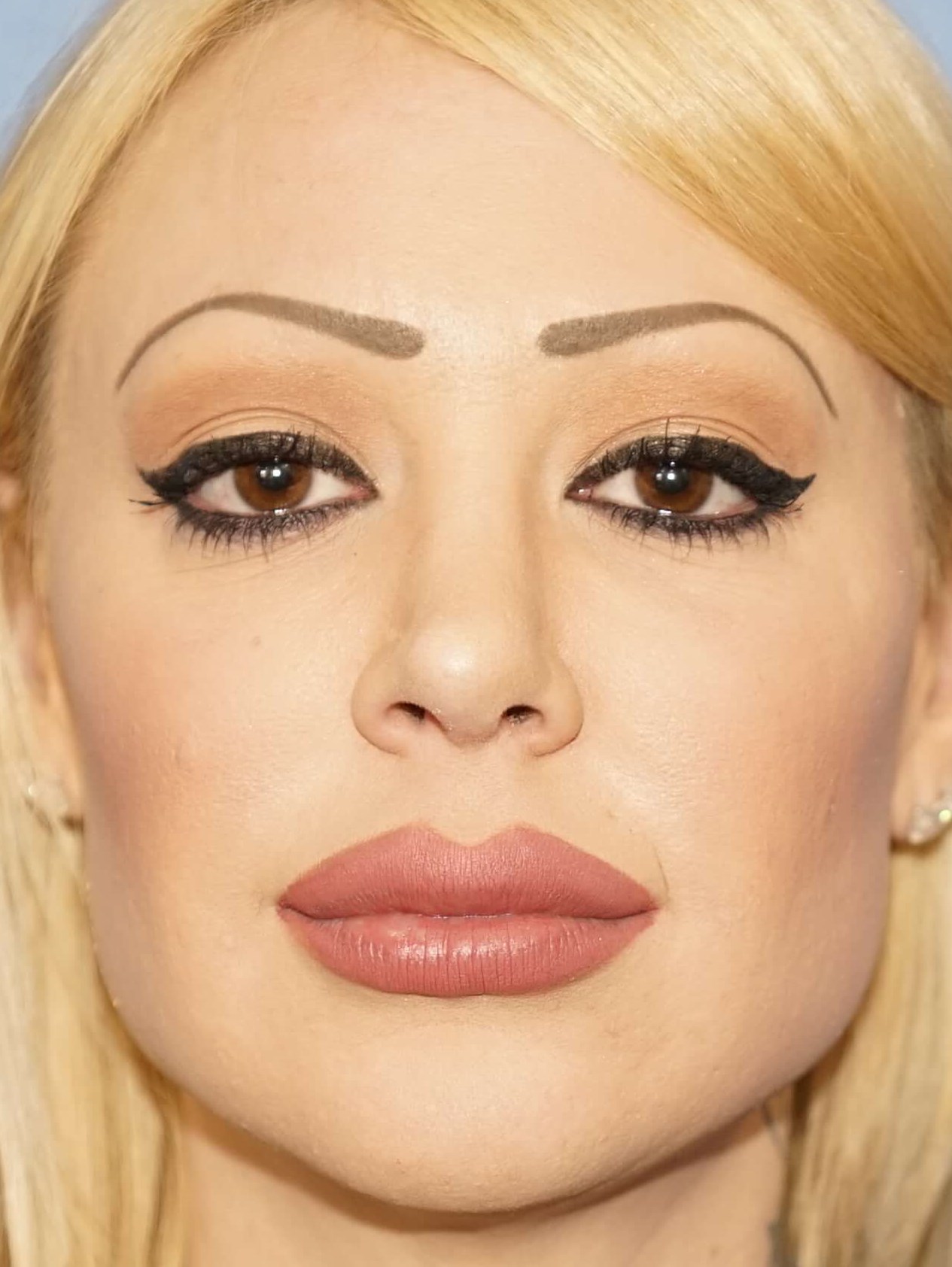 Woman has Facial Rejuvenation After
