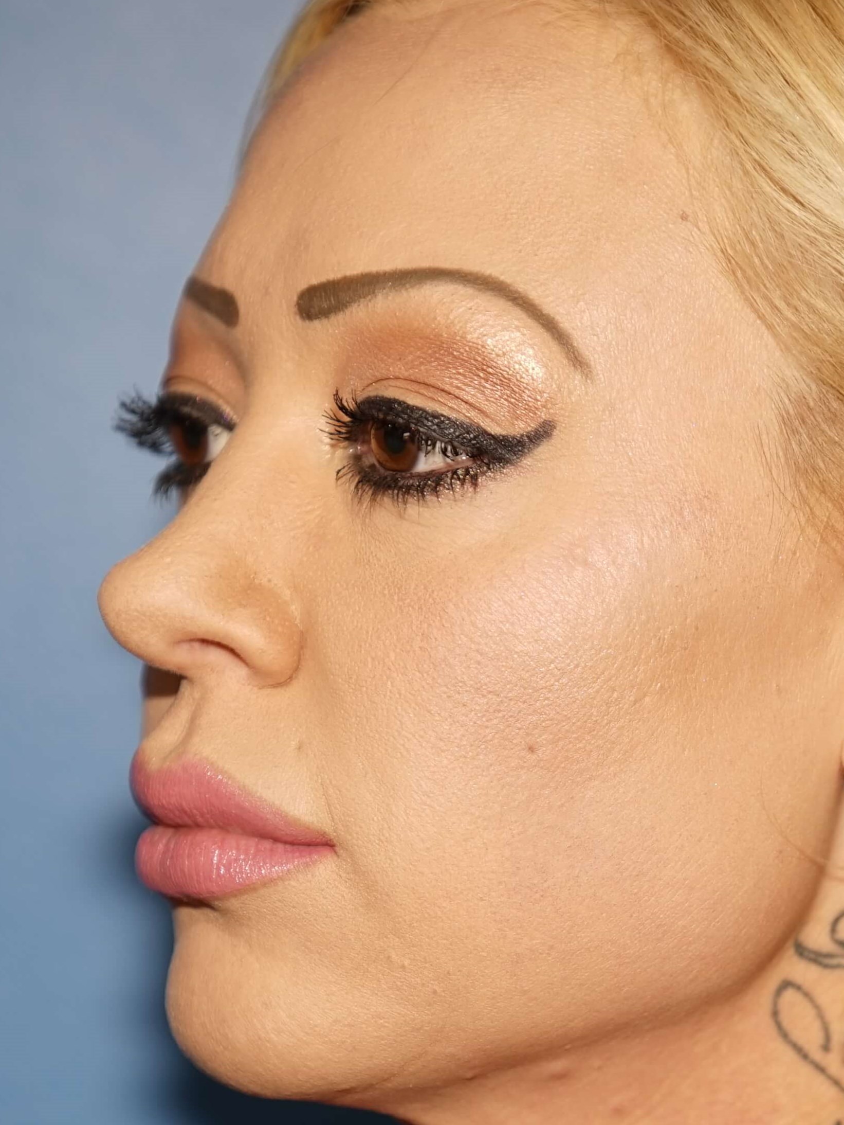 Woman has Facial Rejuvenation Before