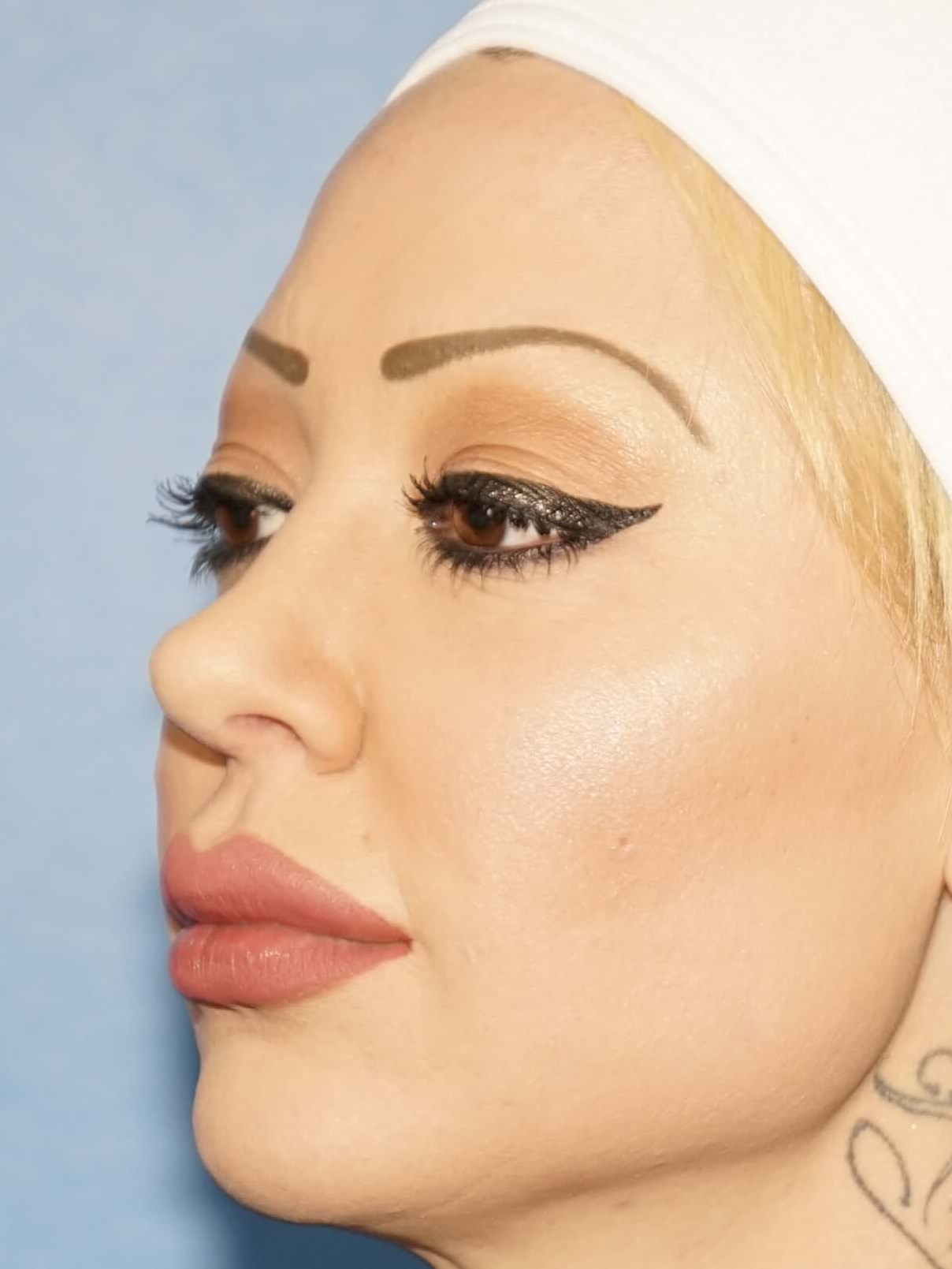 Woman has Facial Rejuvenation After