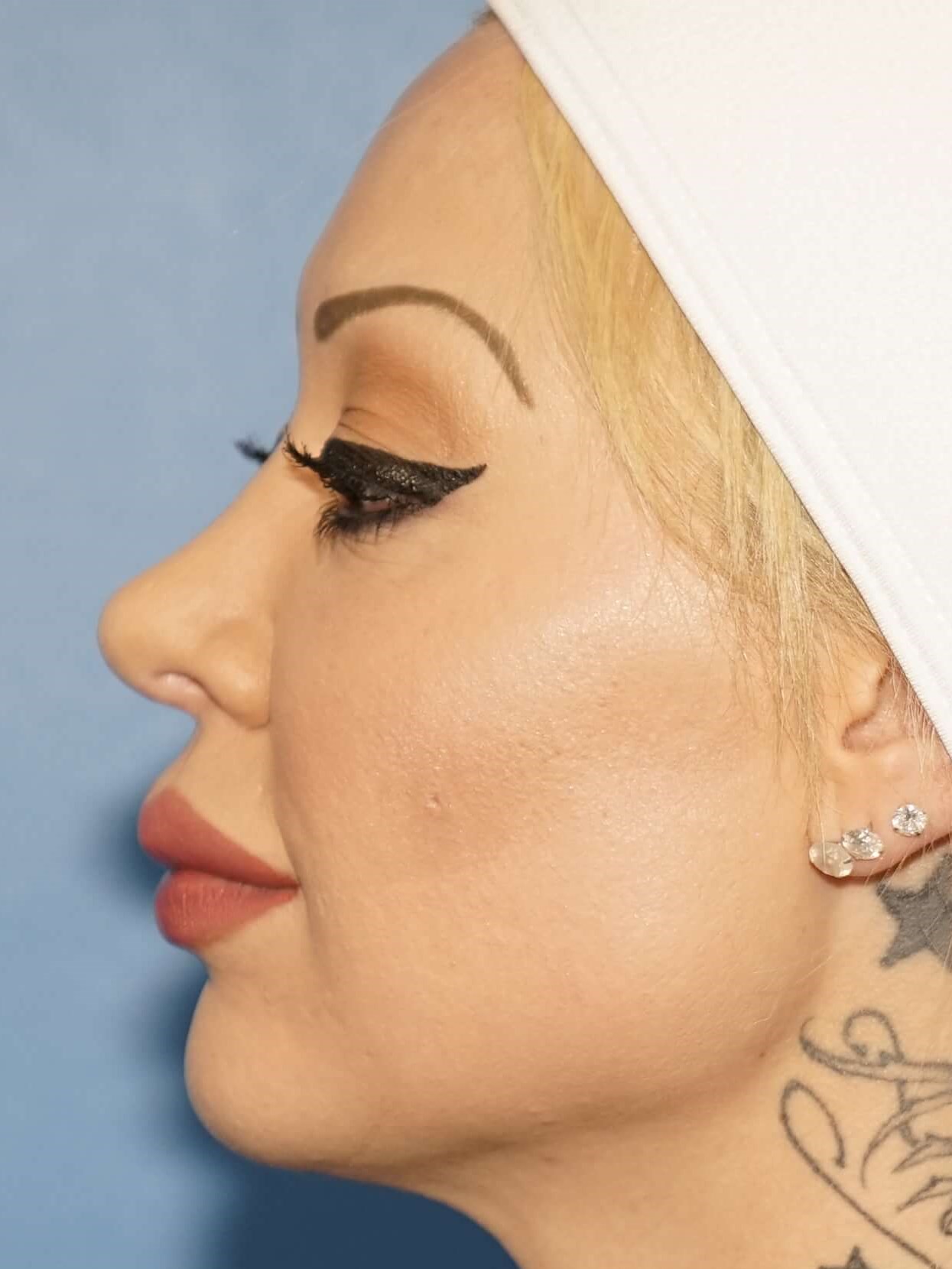 Woman has Facial Rejuvenation After