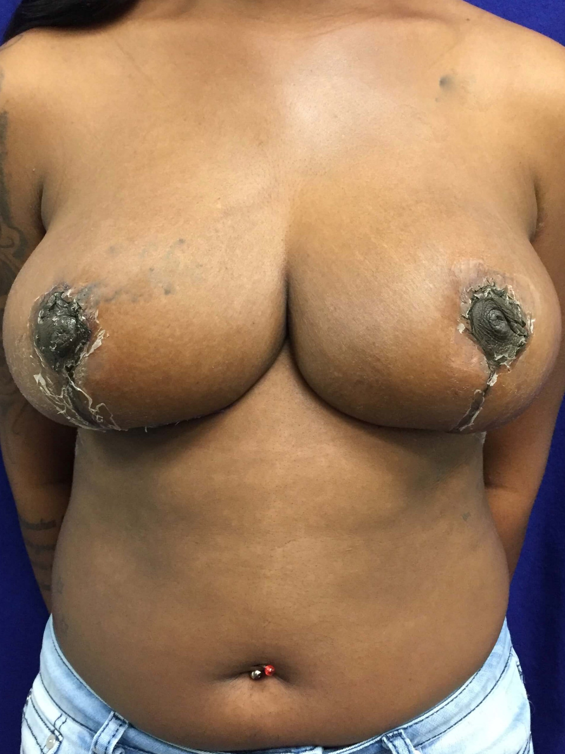 Westlake Woman Has Mastopexy After