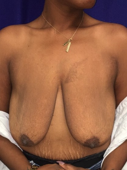 Westlake Woman Has Mastopexy Before