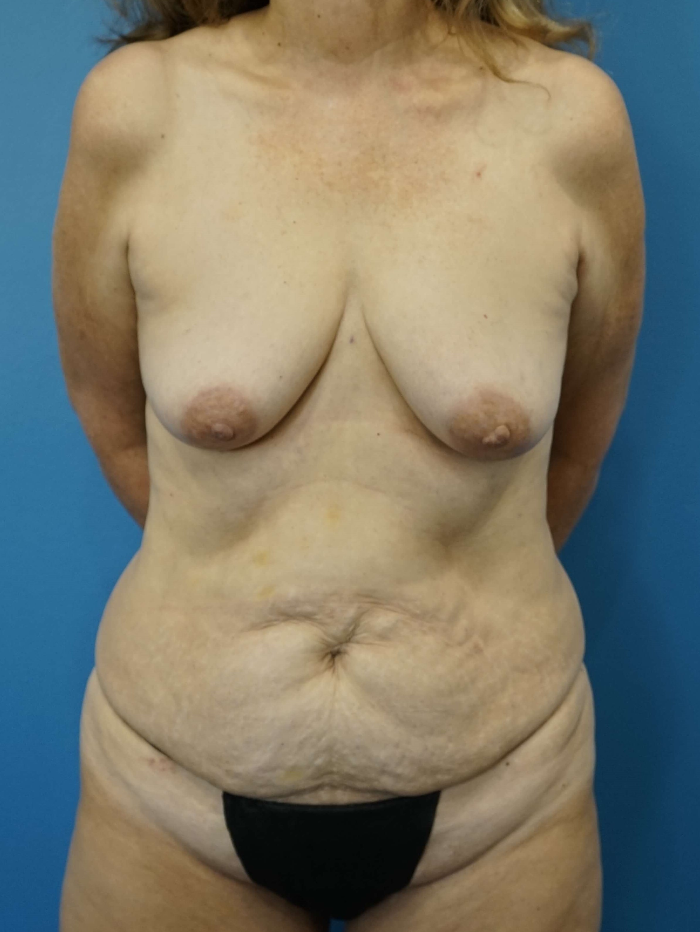 Woman has Mommy Makeover Before