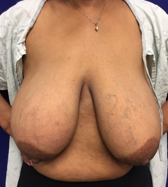 Westlake Woman Has Mastopexy Before