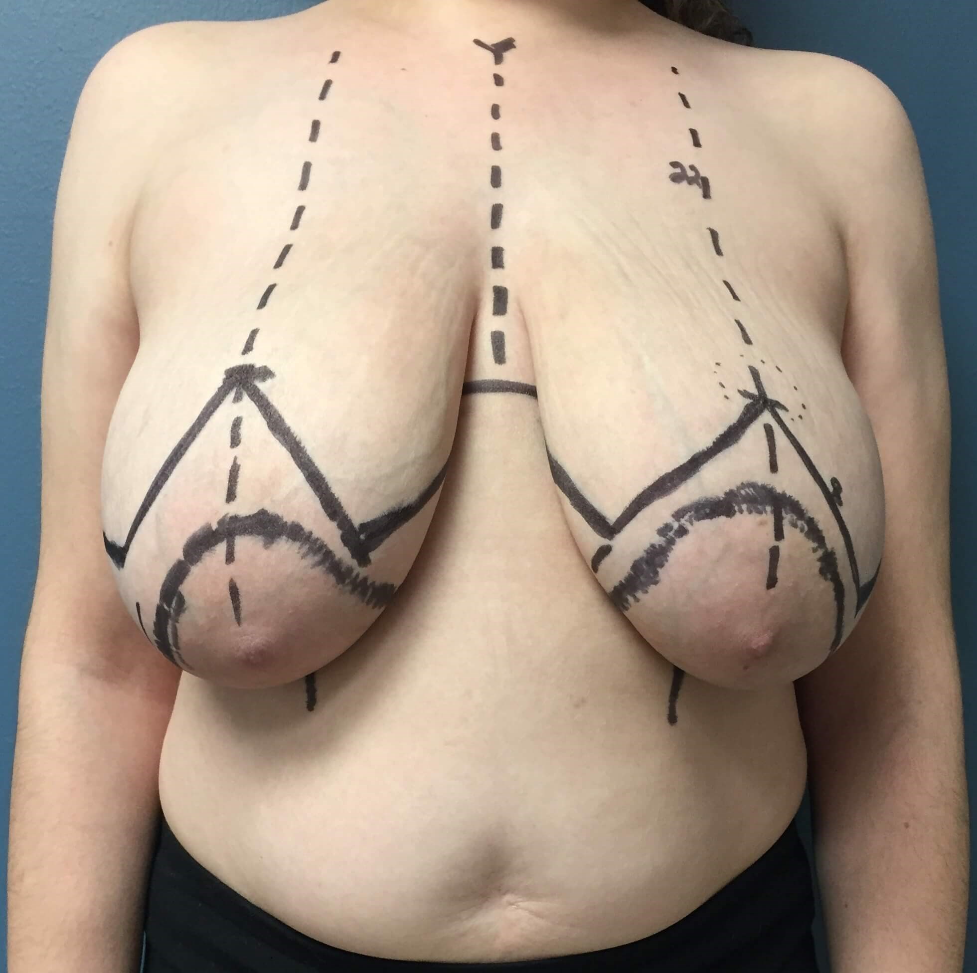 Westlake Woman Has Mastopexy Before
