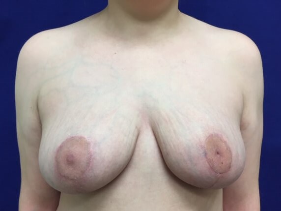 Westlake Woman Has Mastopexy After