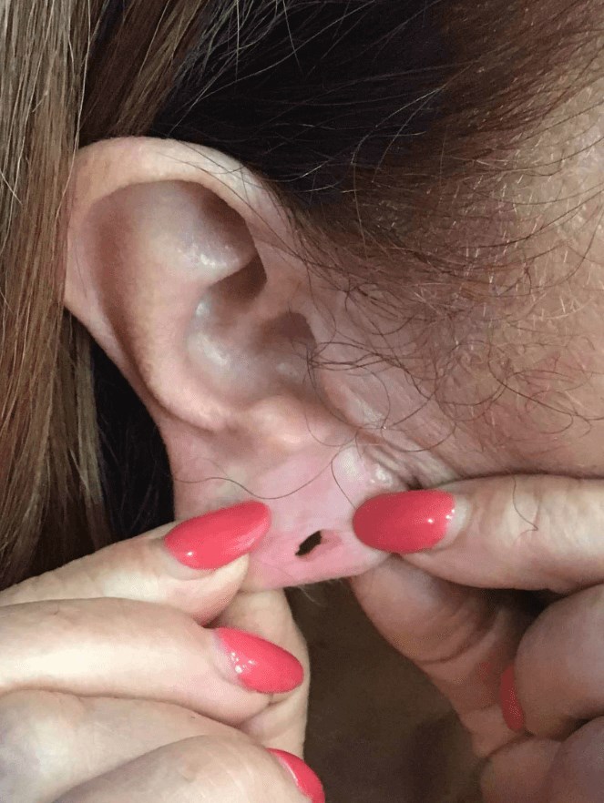 Westlake Woman has Otoplasty Before
