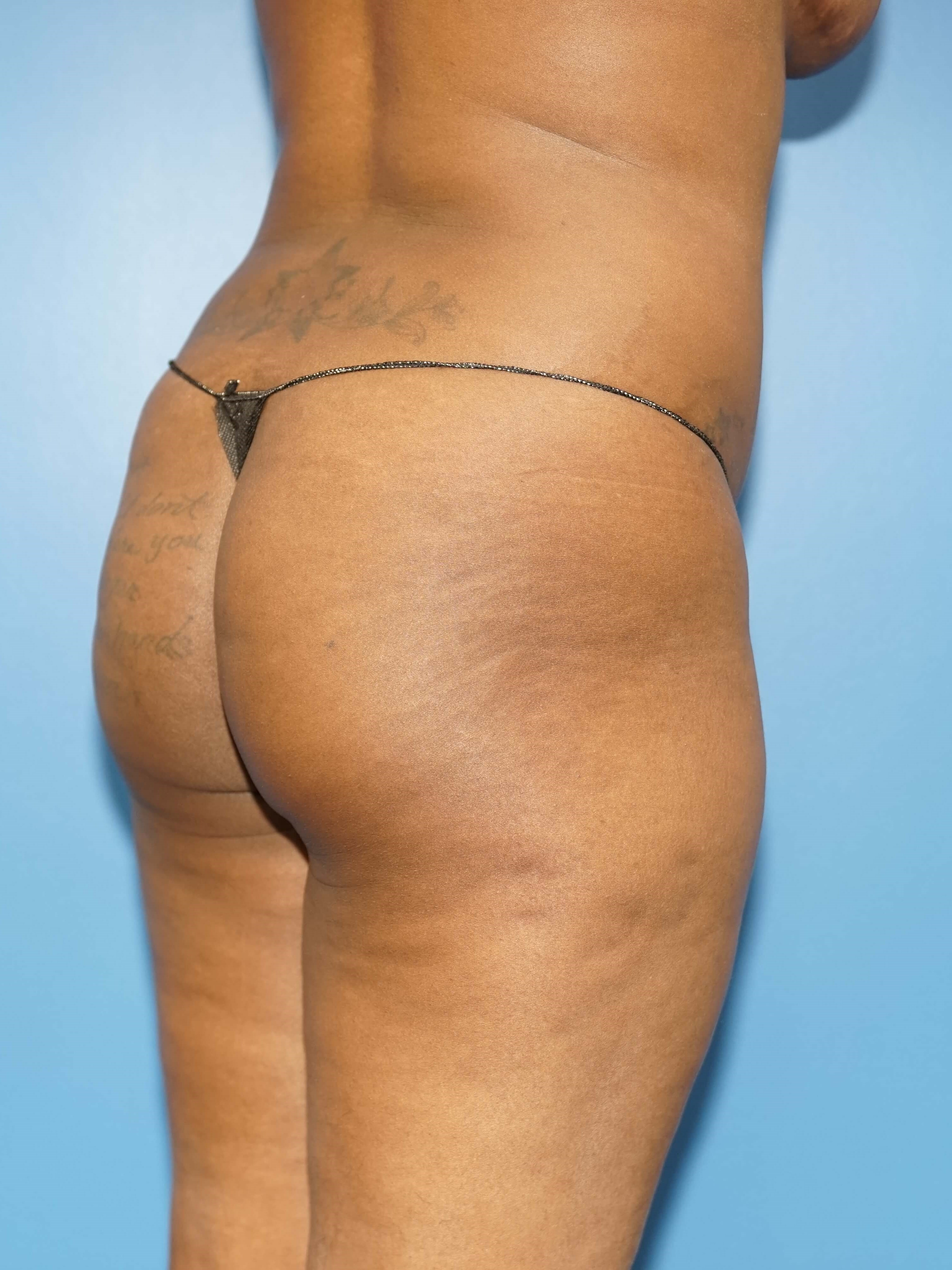 Woman has Fat Transfer to Butt Before