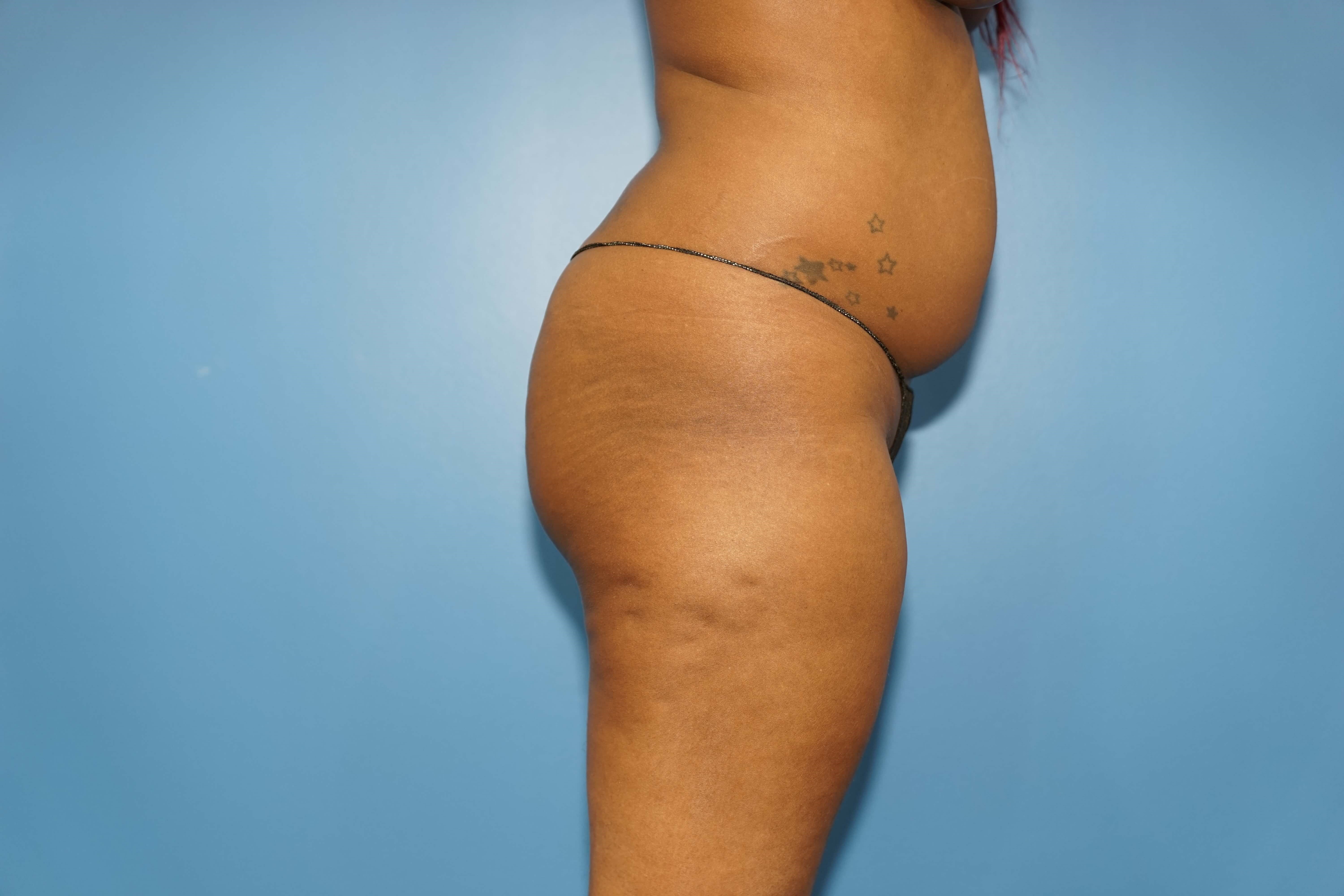 Woman has Butt Lift Before
