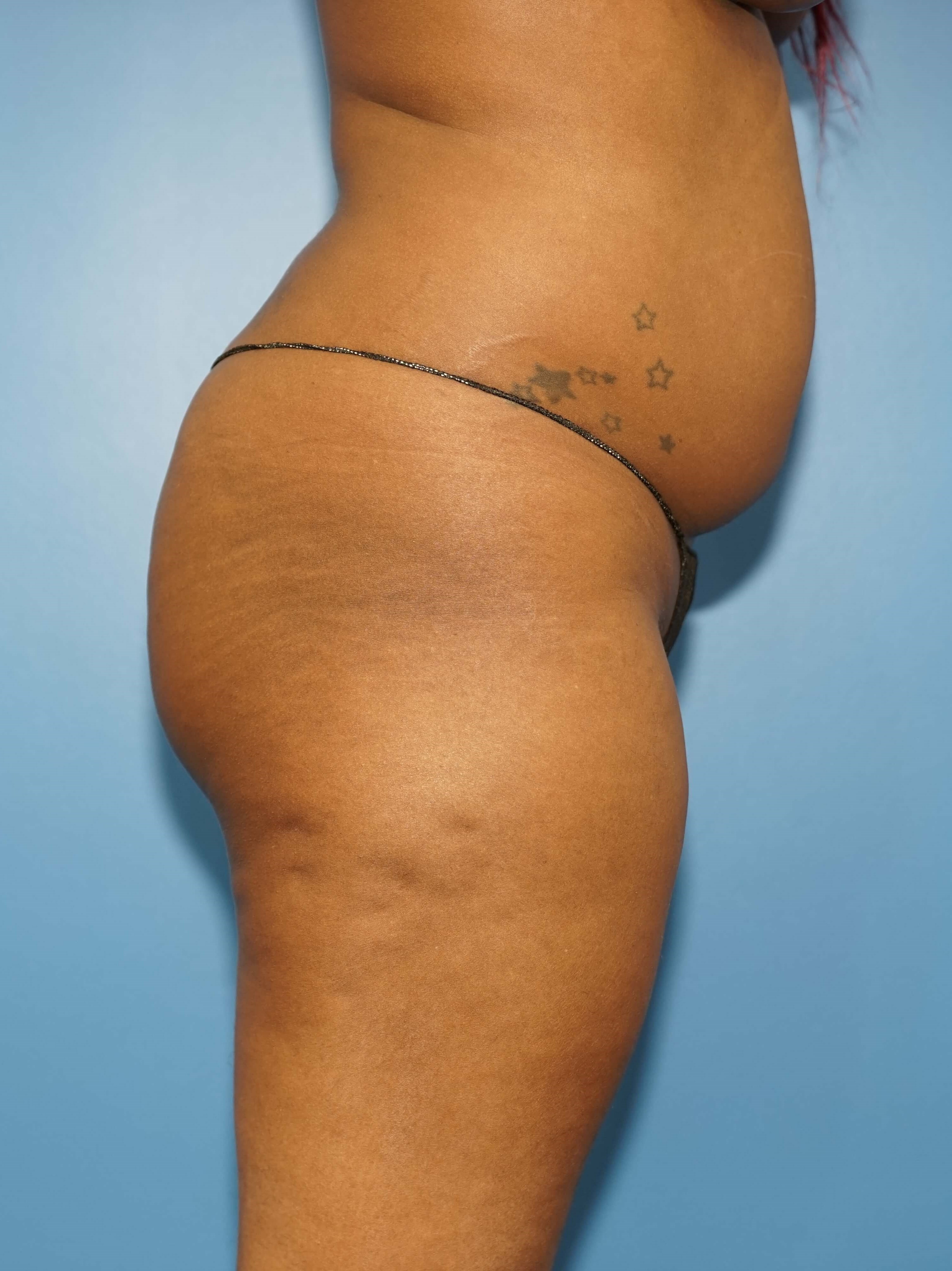 Woman has Butt Lift Before