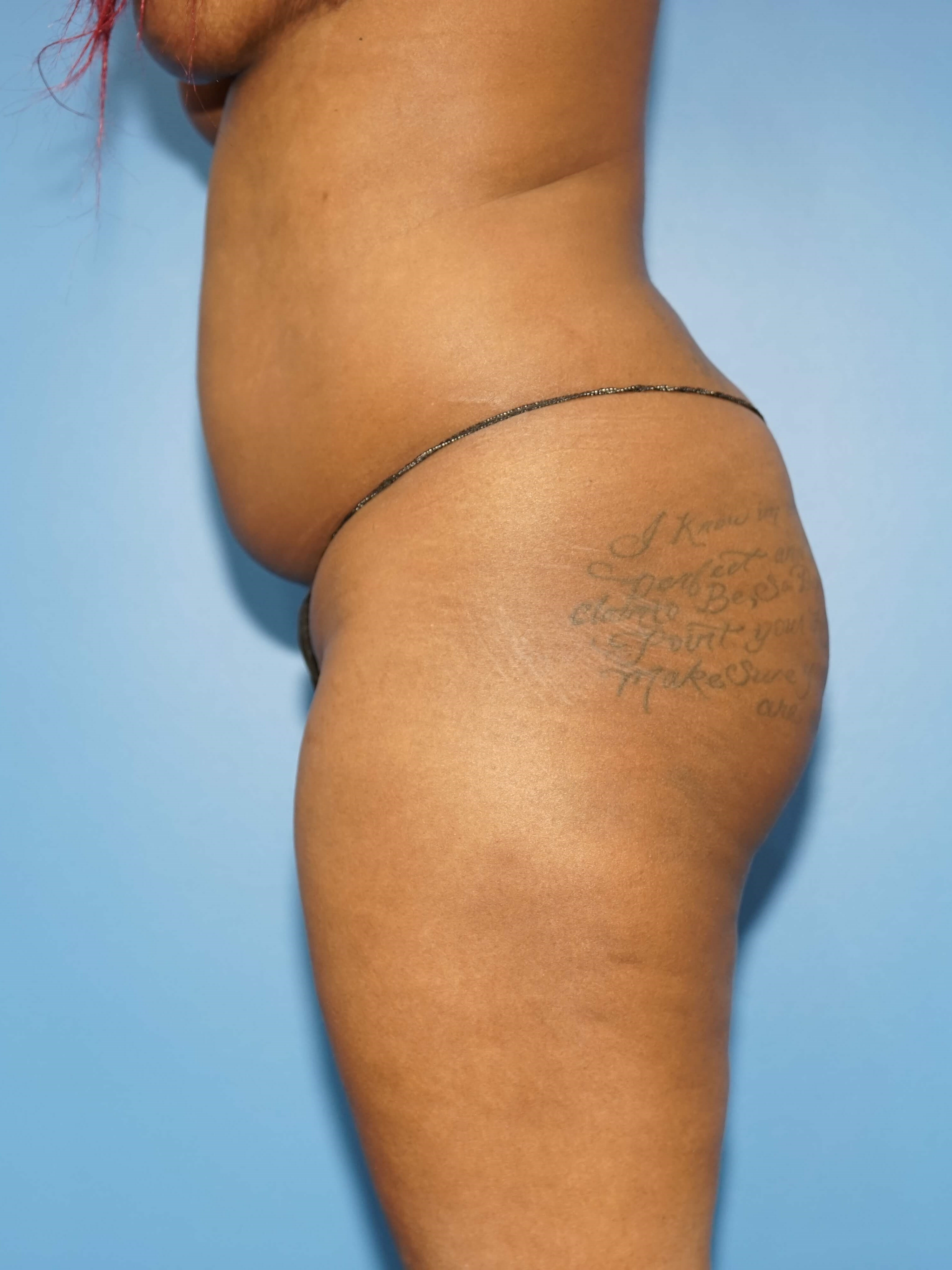 Woman has Butt Lift Before