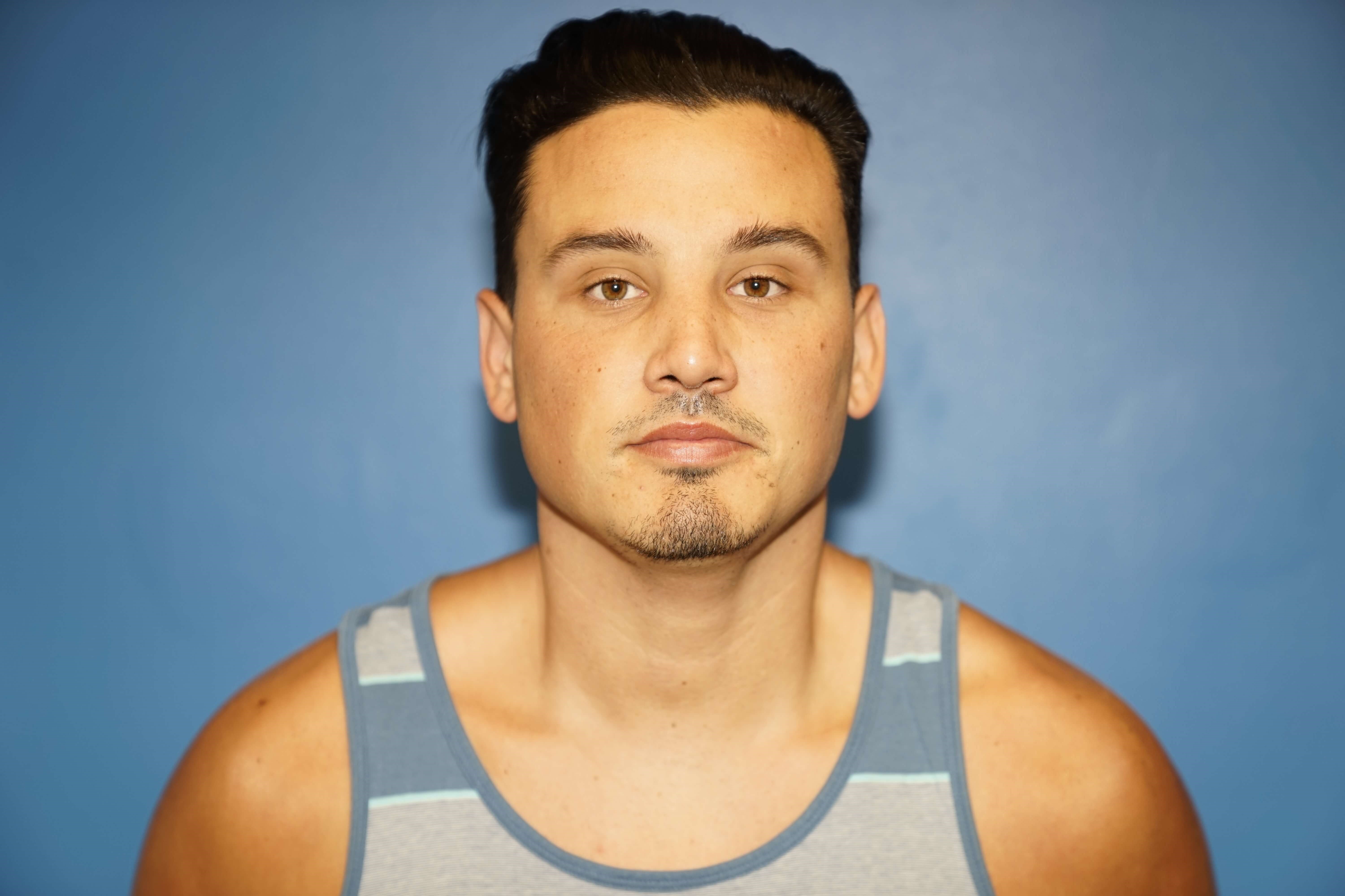 Man has Revision Rhinoplasty After