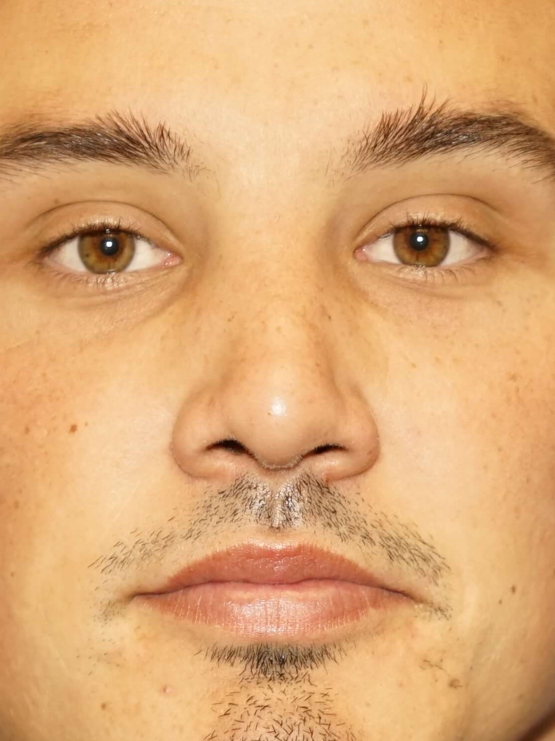 Man has Revision Rhinoplasty After
