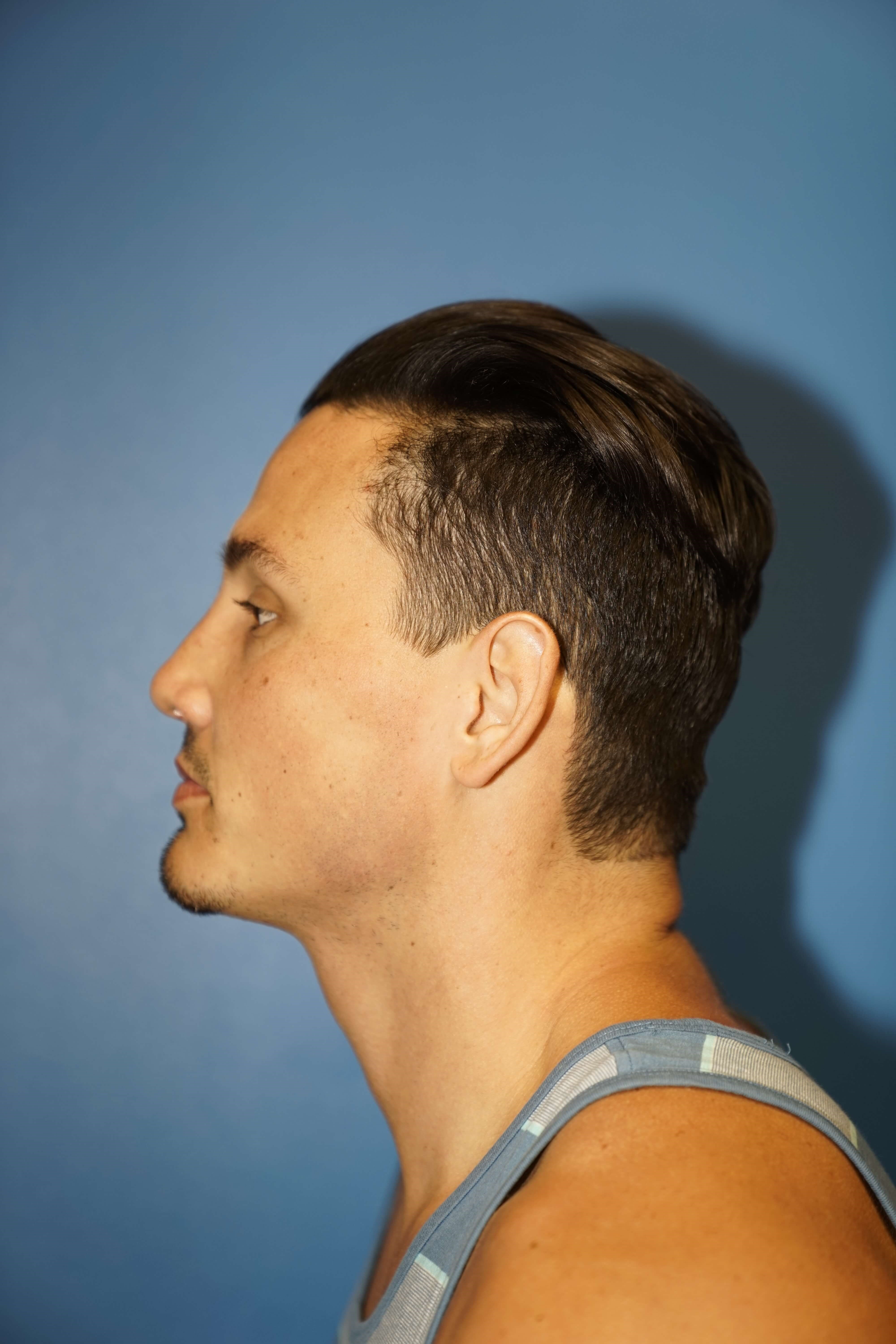 Man has Revision Rhinoplasty After