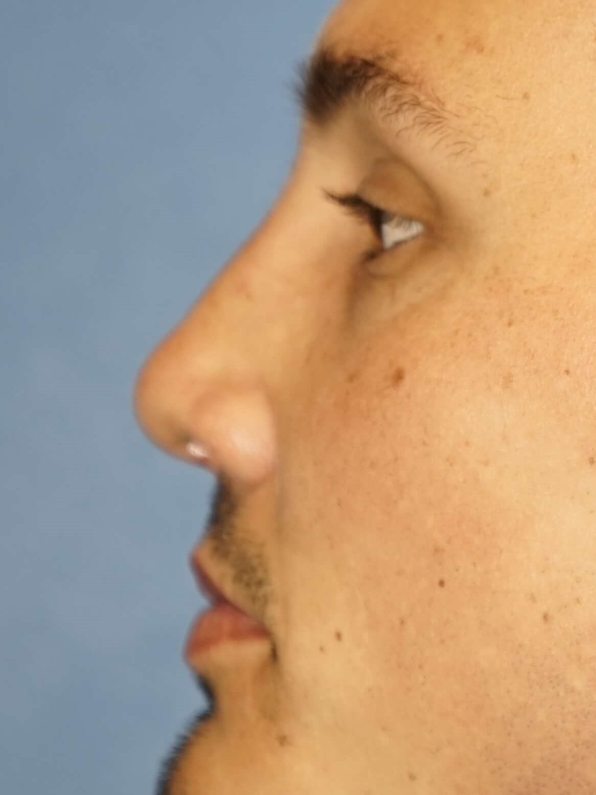 Man has Revision Rhinoplasty After