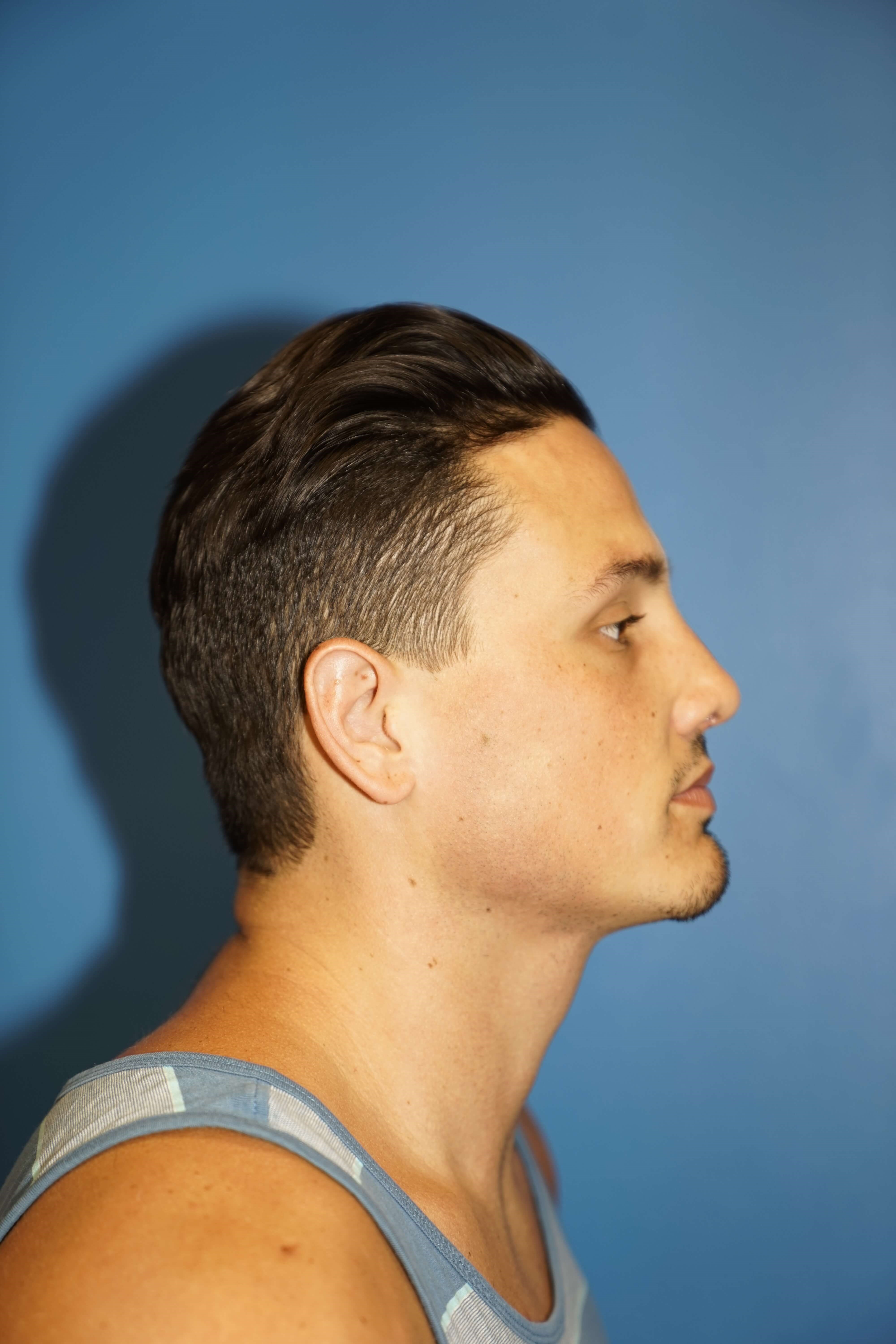 Man has Revision Rhinoplasty After