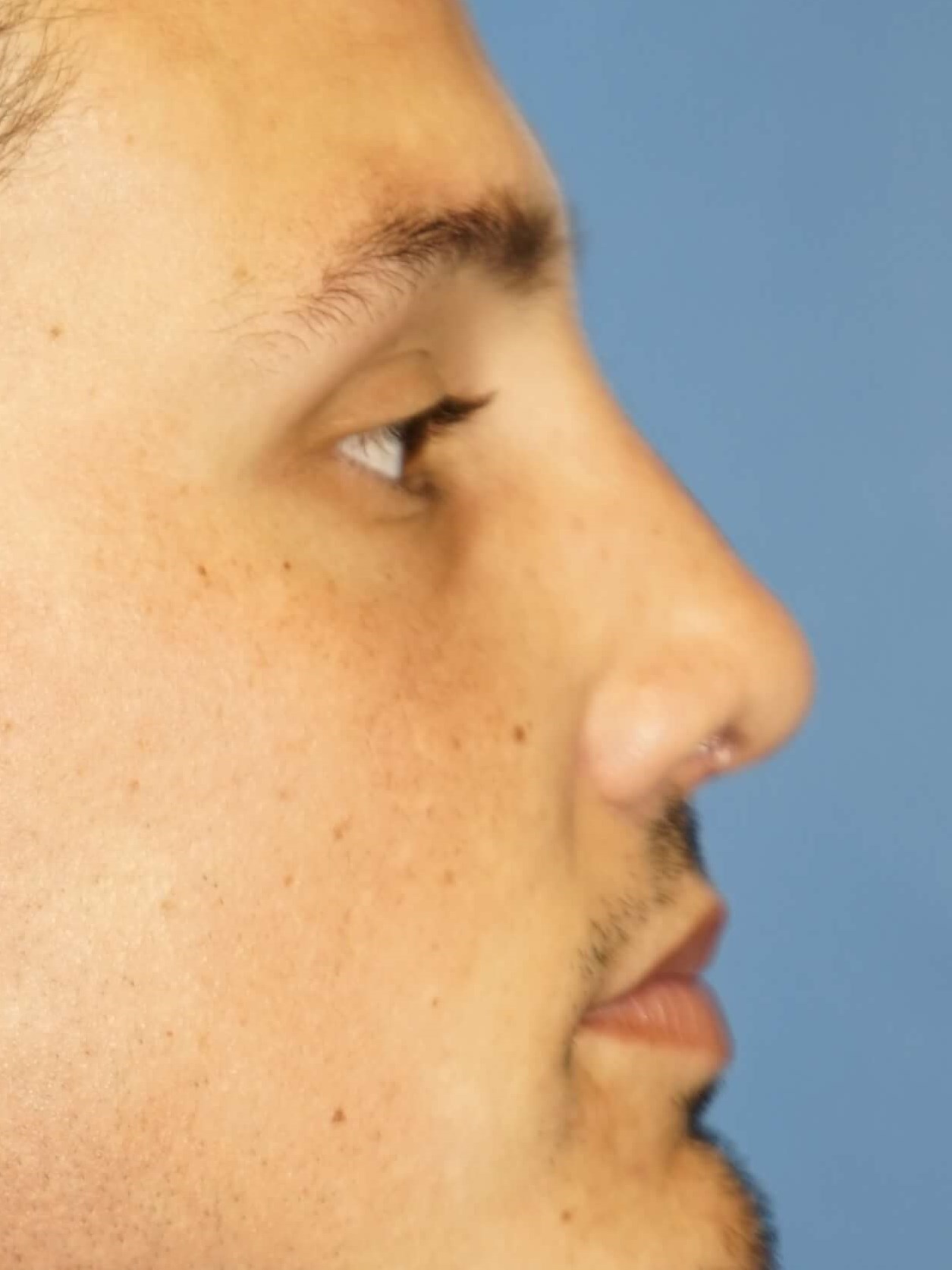 Man has Revision Rhinoplasty After