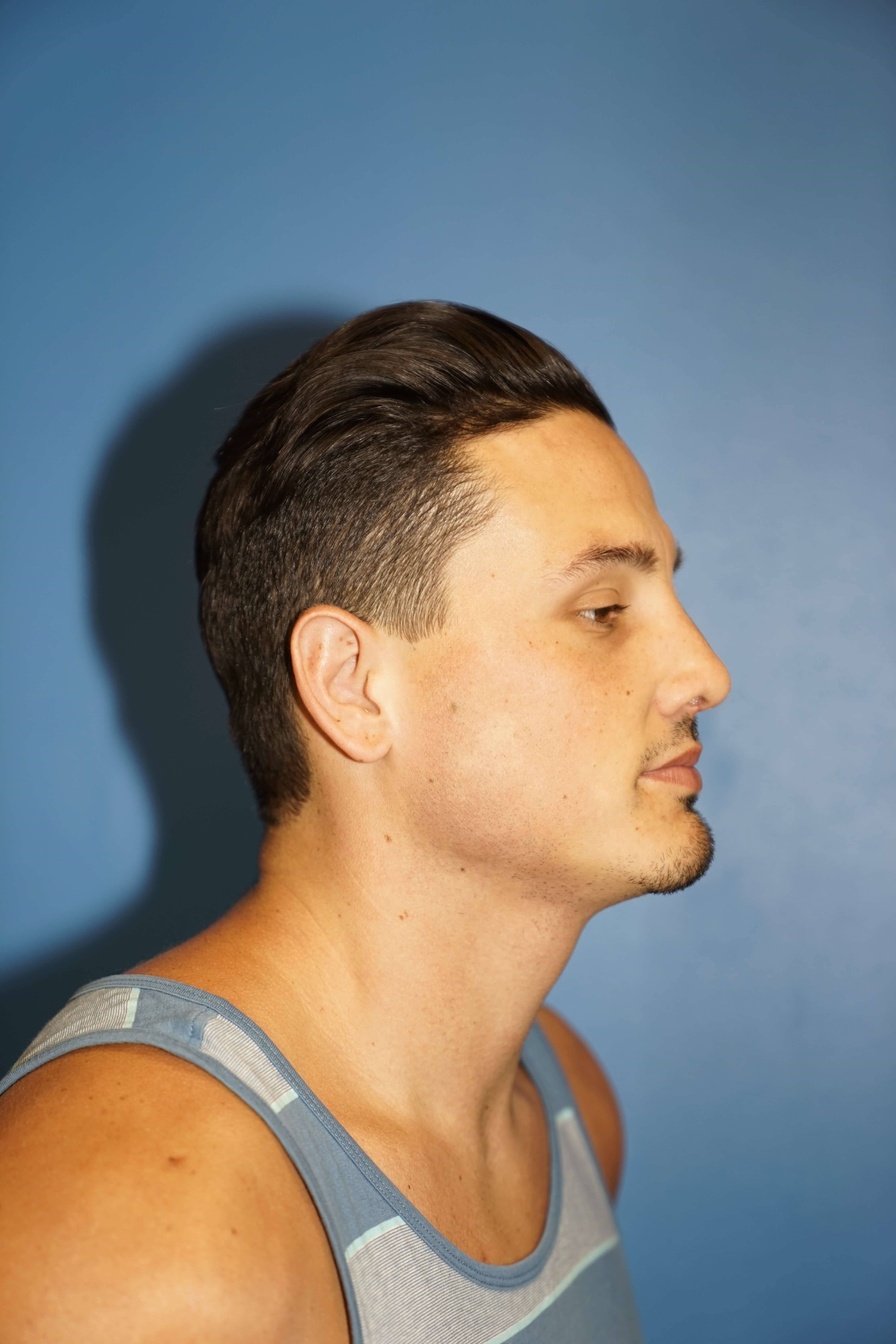 Man has Revision Rhinoplasty After