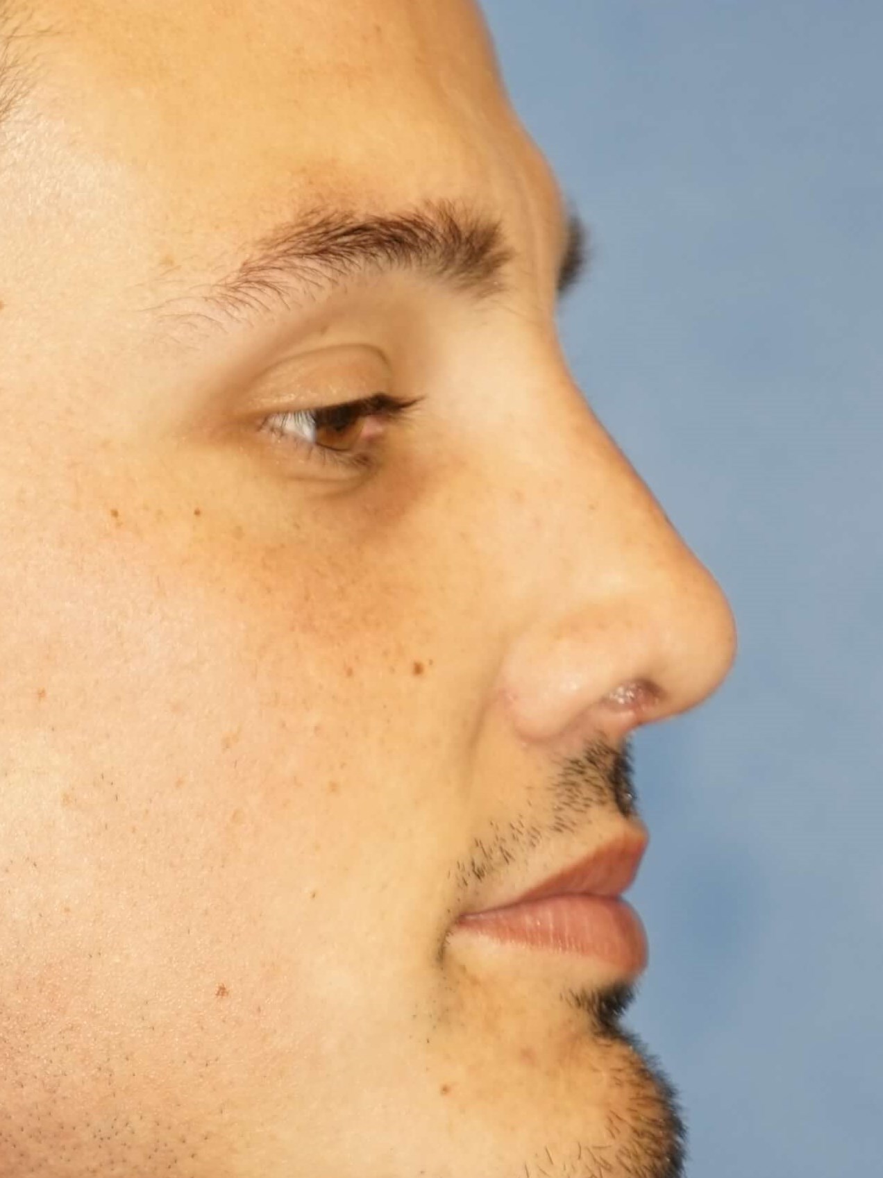 Man has Revision Rhinoplasty After