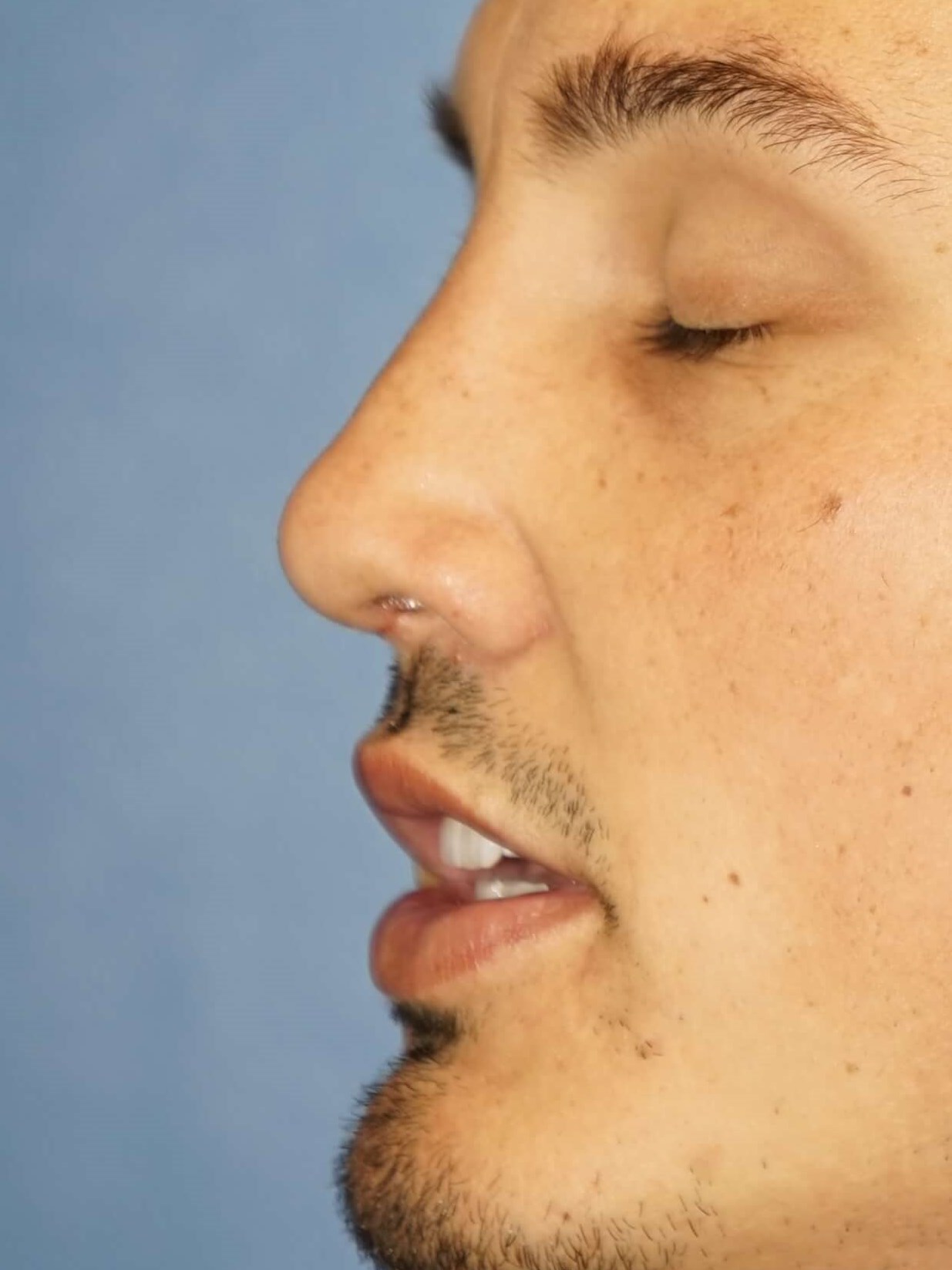 Man has Revision Rhinoplasty After