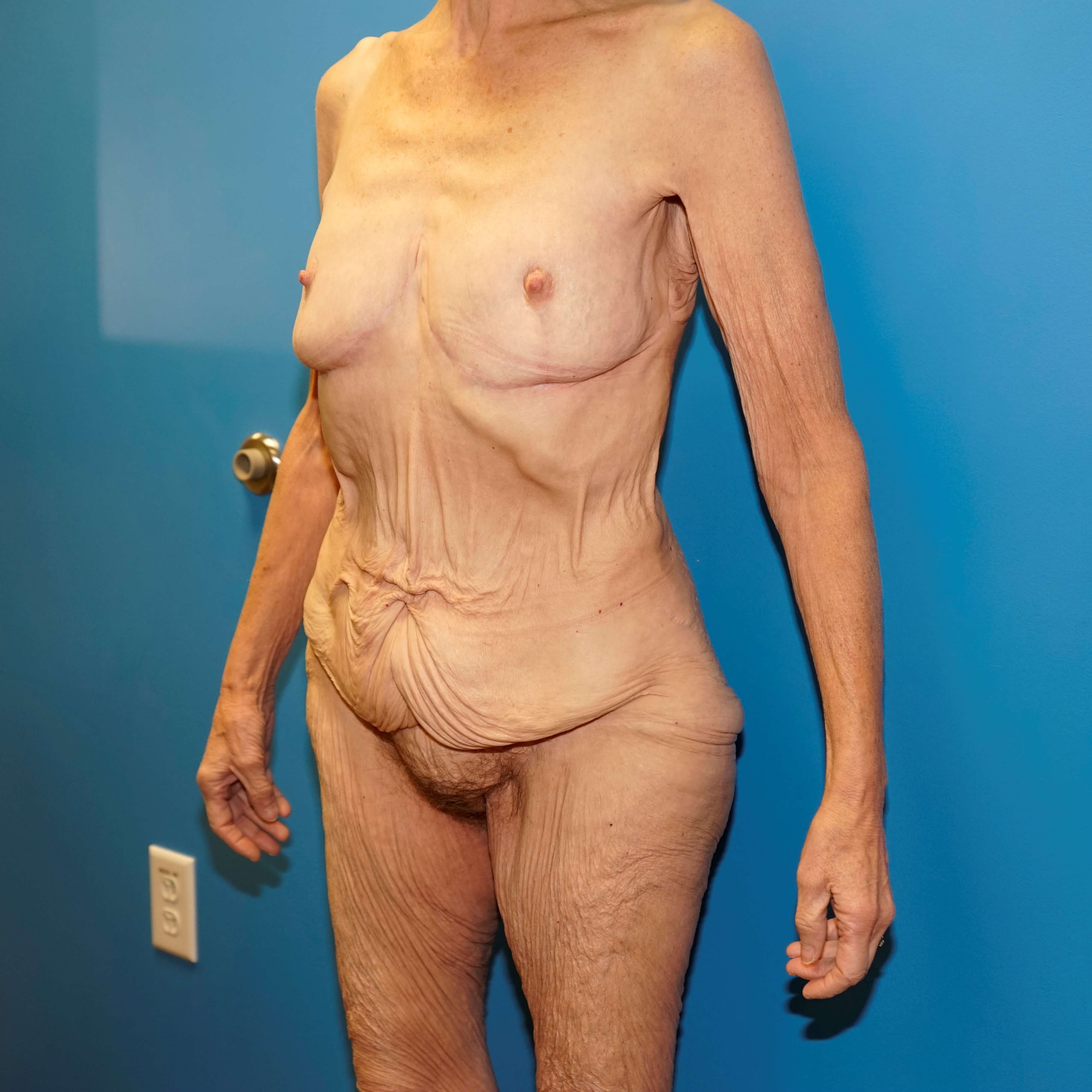 Westlake Woman Has Tummy Tuck Before