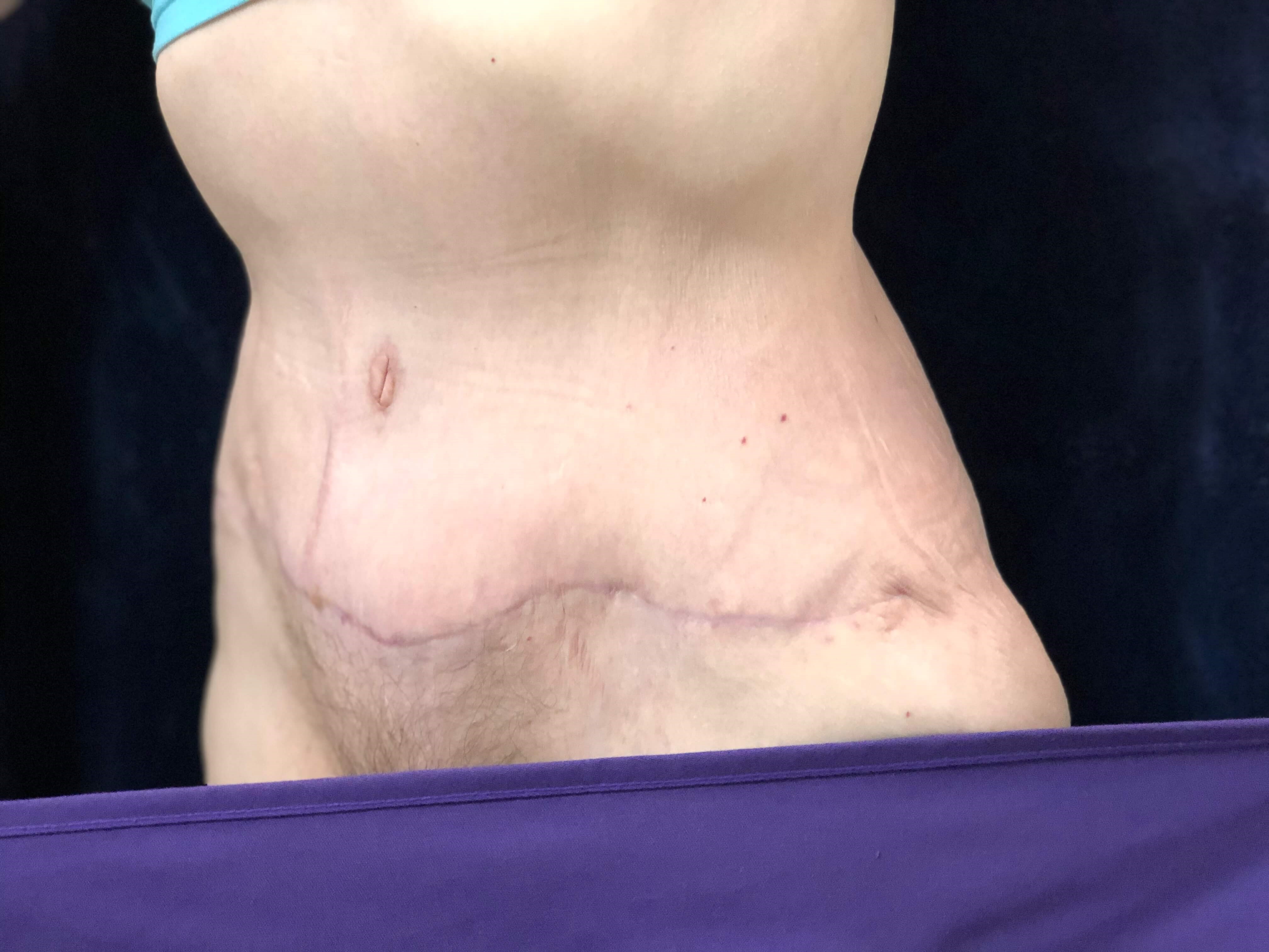 Westlake Woman Has Tummy Tuck After